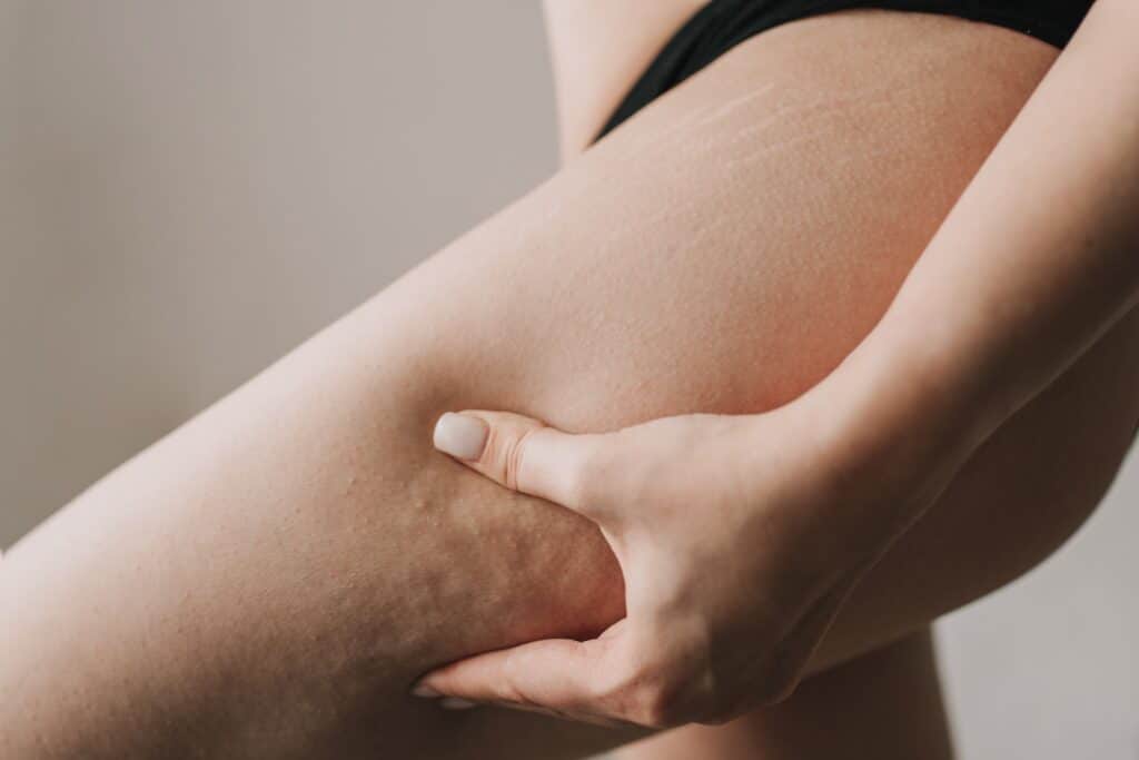 Laser Skin Tightening Cellulite