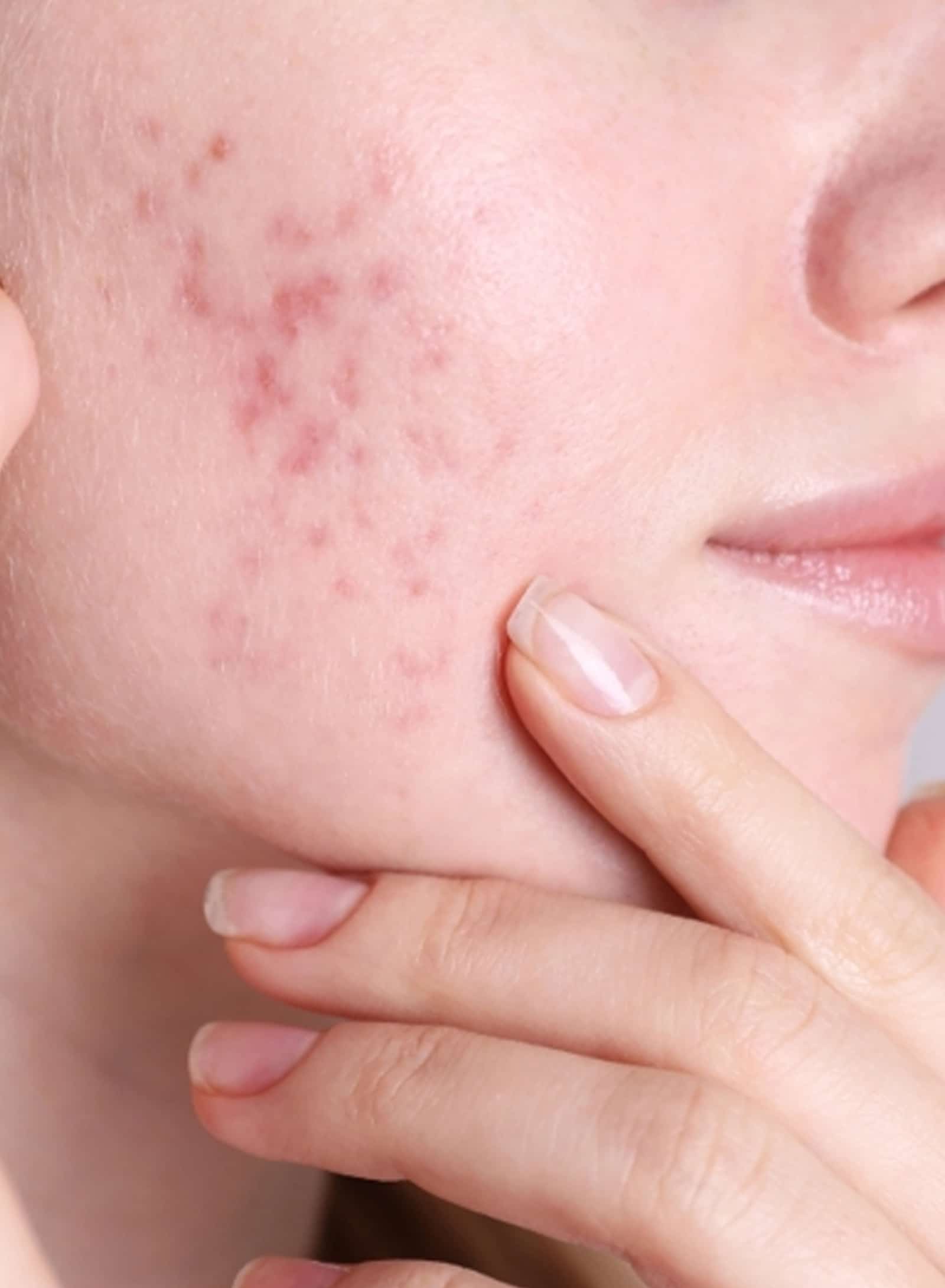 Acne Scar Treatment