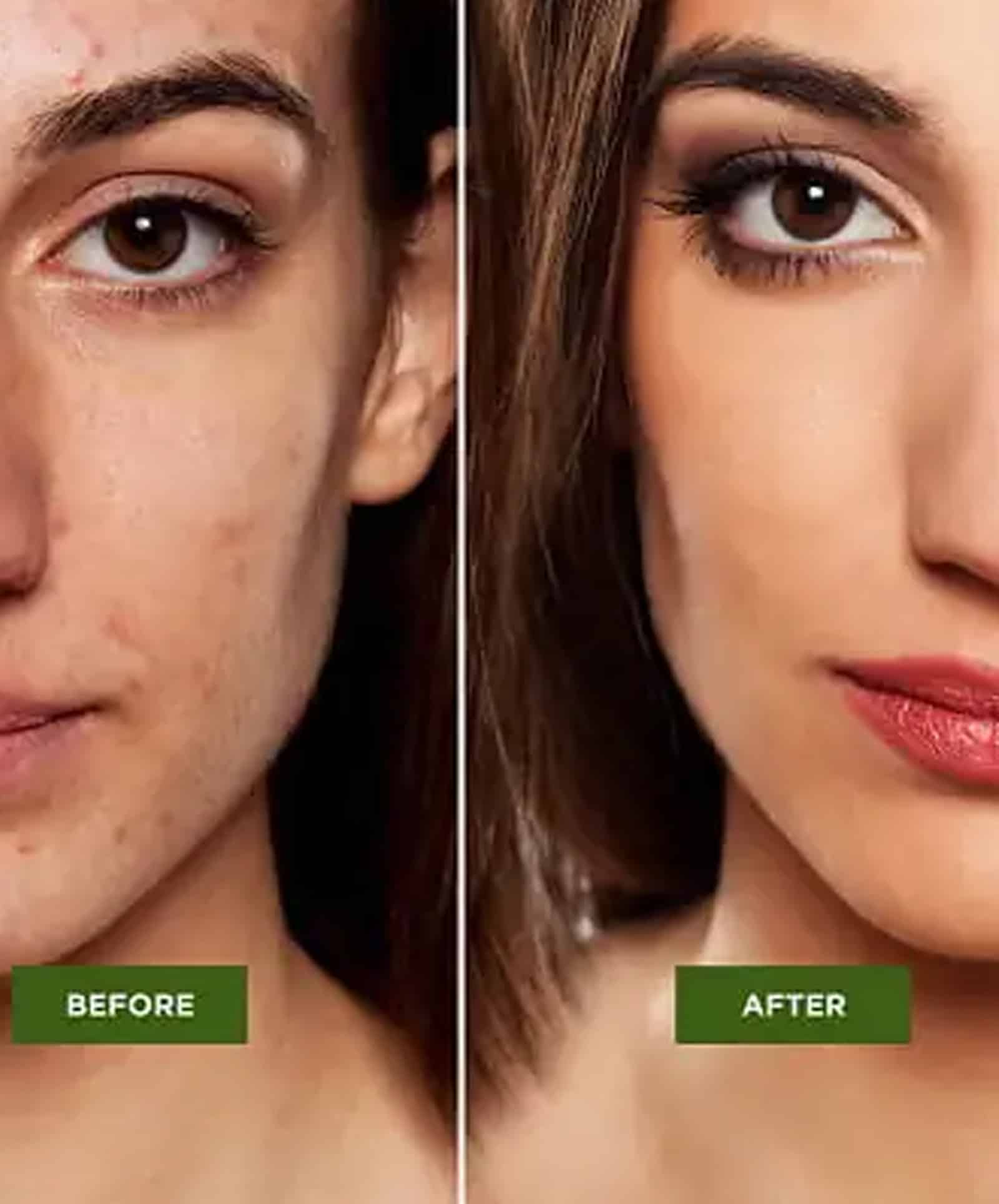 Acne Scar Treatments at Wymore Laser Acne Scar Treatments at Wymore Laser