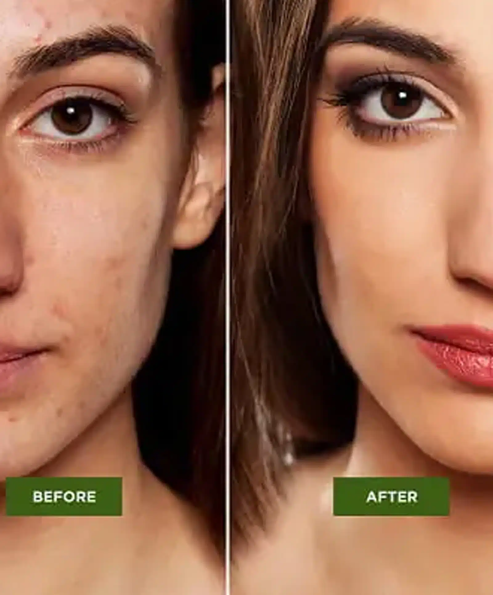 Acne Scar Treatments at Wymore Laser Acne Scar Treatments at Wymore Laser