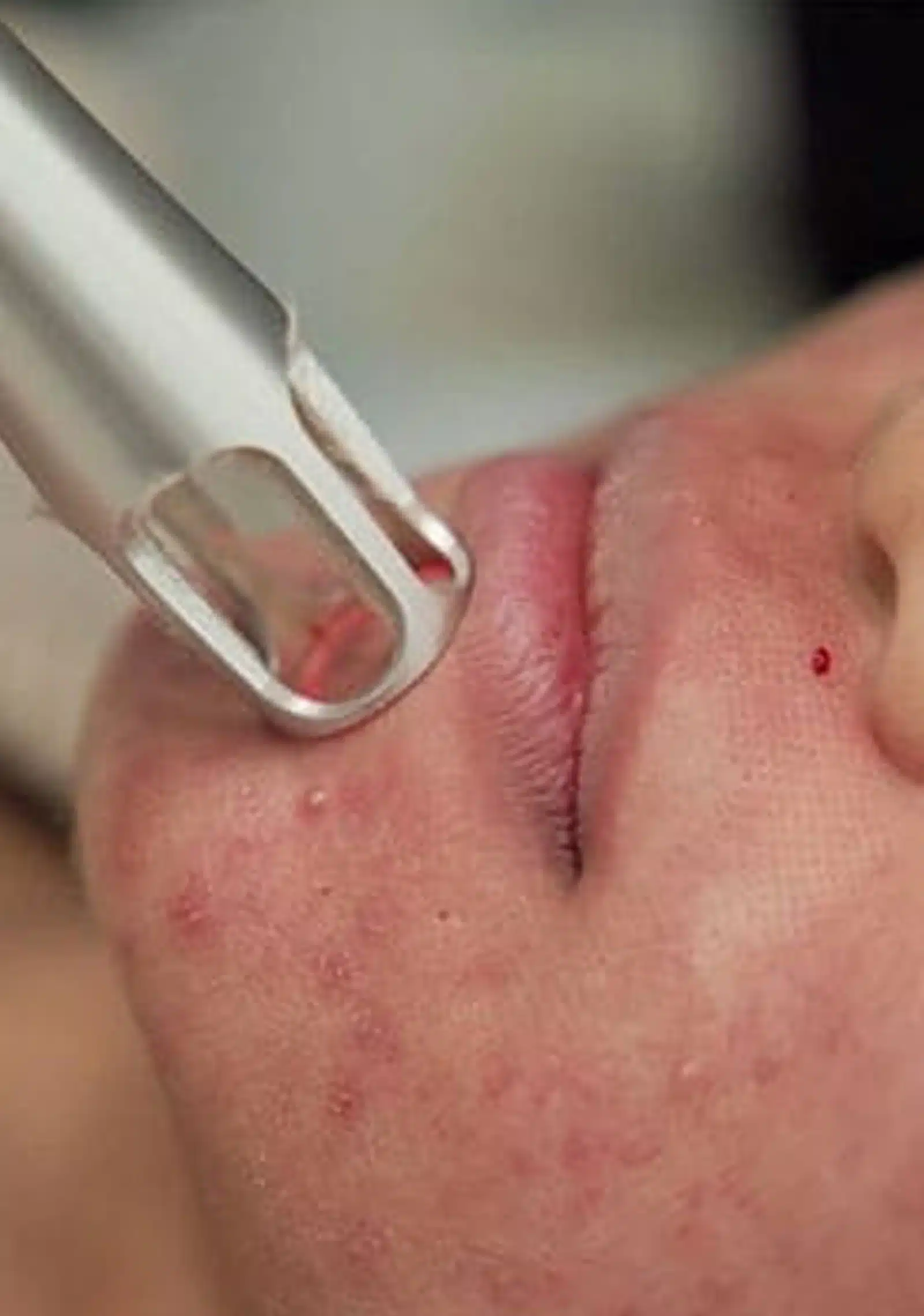 Causes Acne Scars Causes Acne Scars