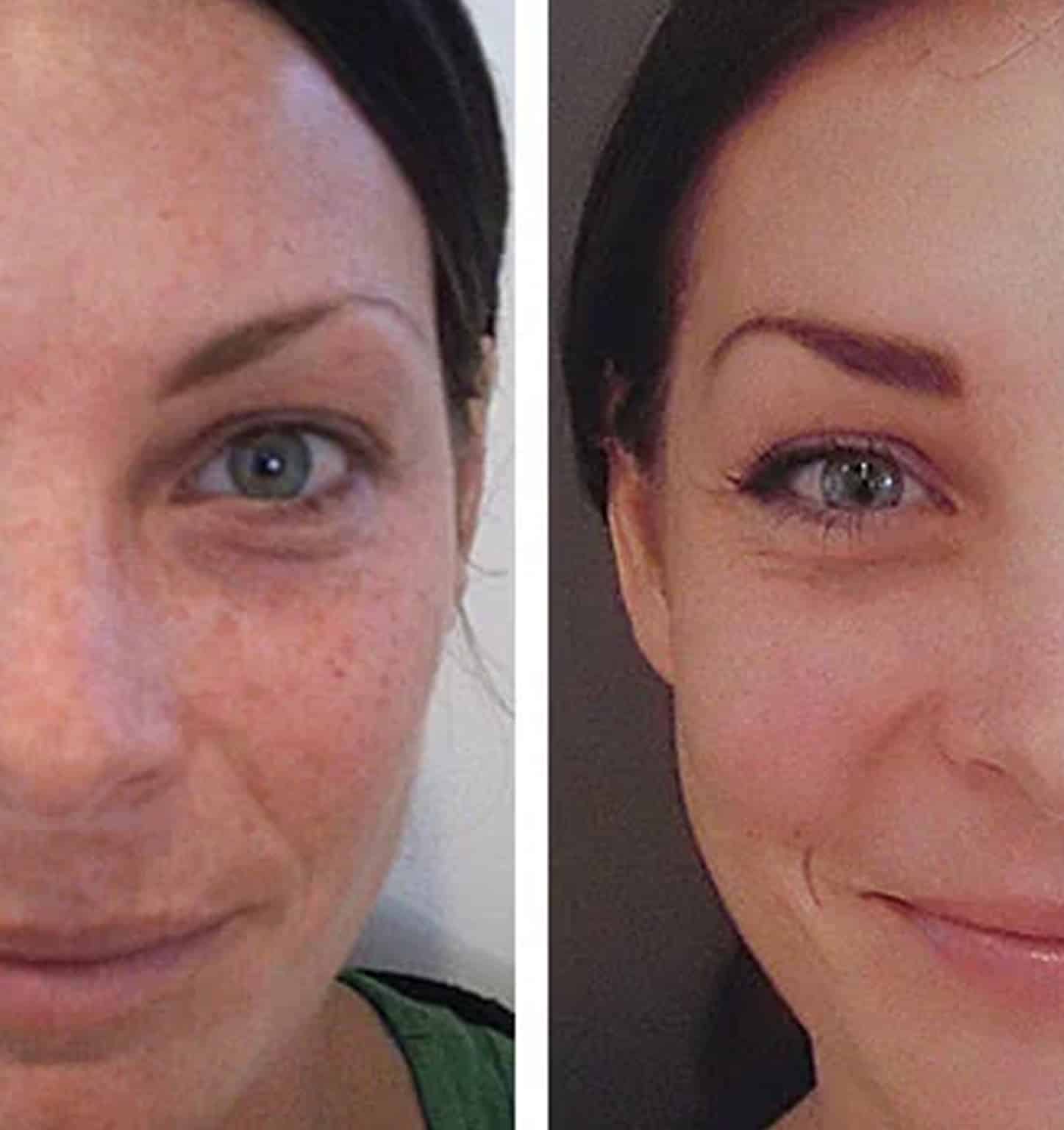 Chemical Peel Orlando F Chemical Peel Orlando F