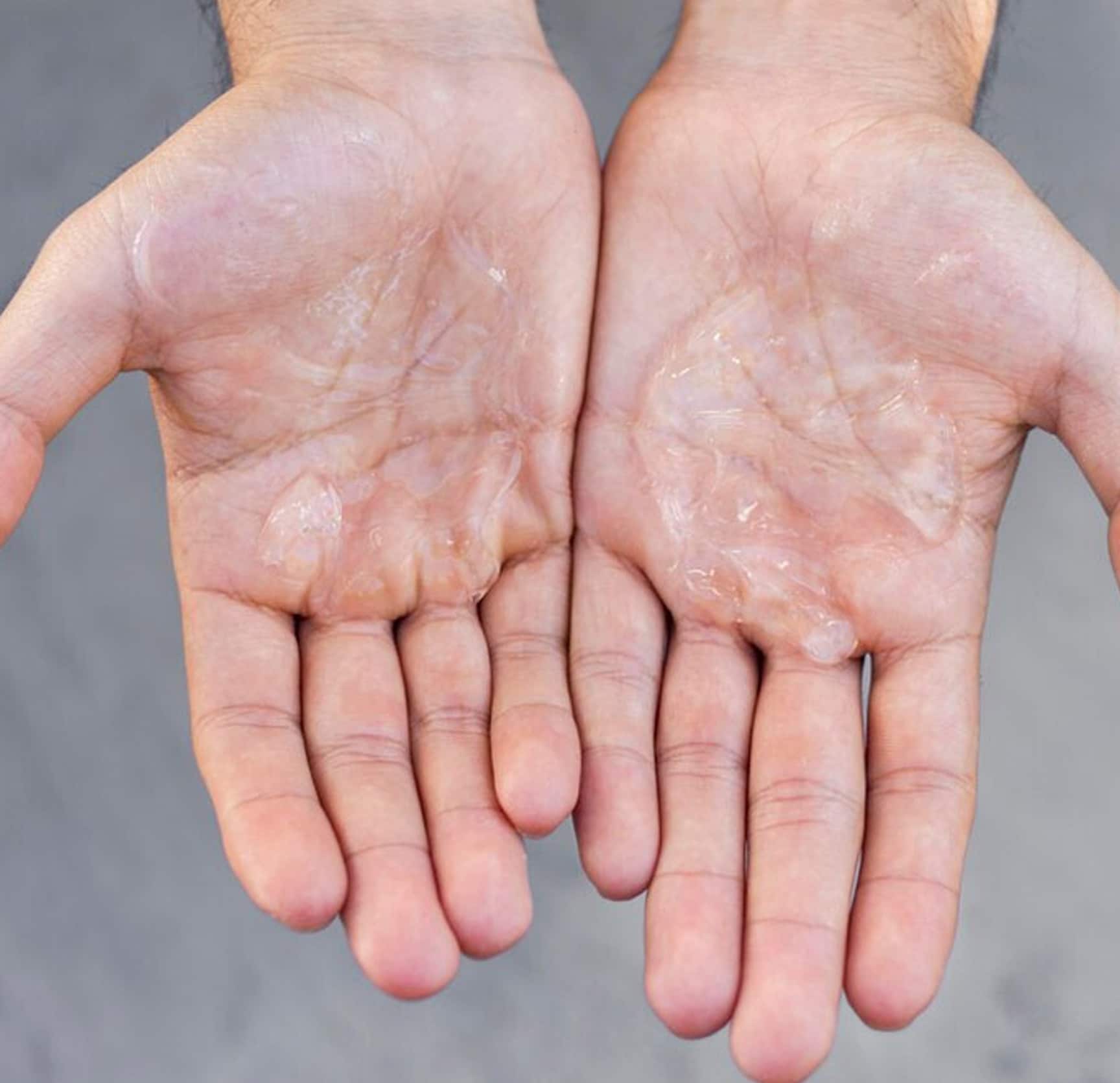 Treatments for hyperhidrosis