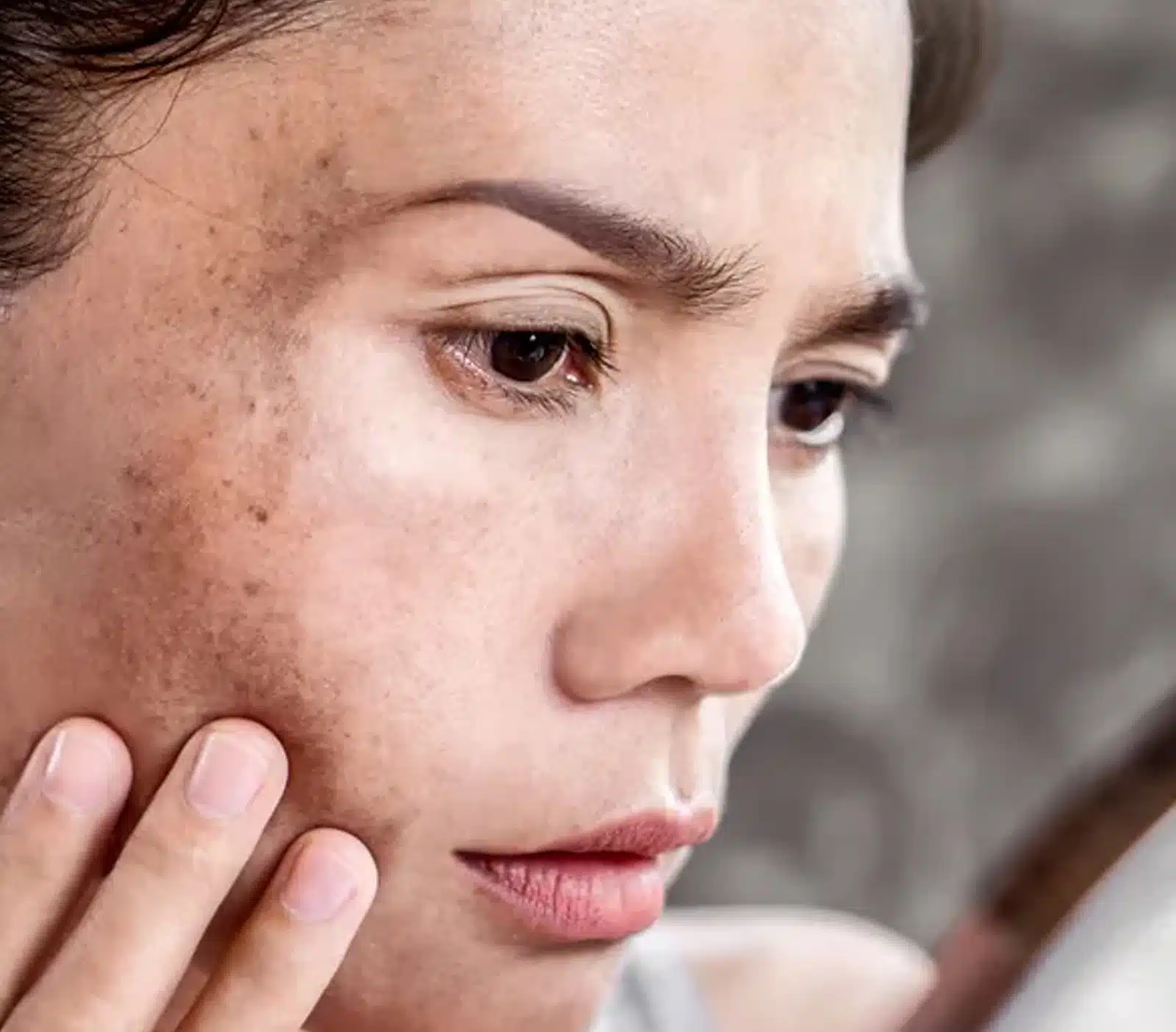 Fades Pigmentation and Sun Damage Fades Pigmentation and Sun Damage