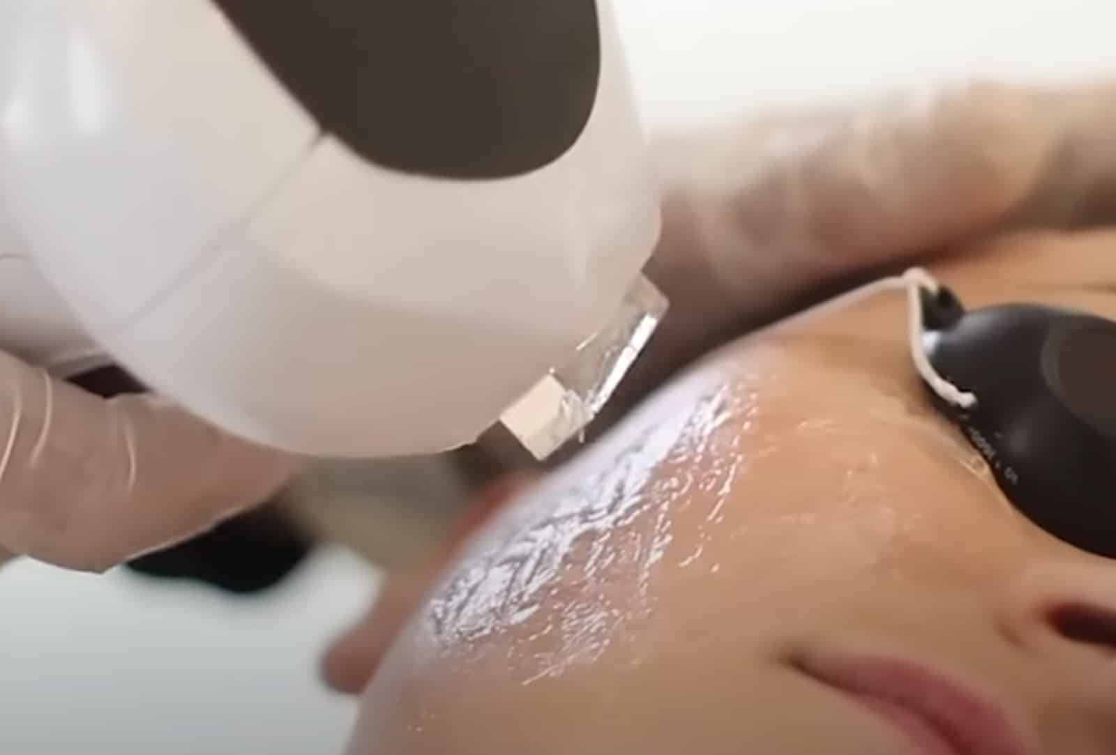 IPL Photofacial