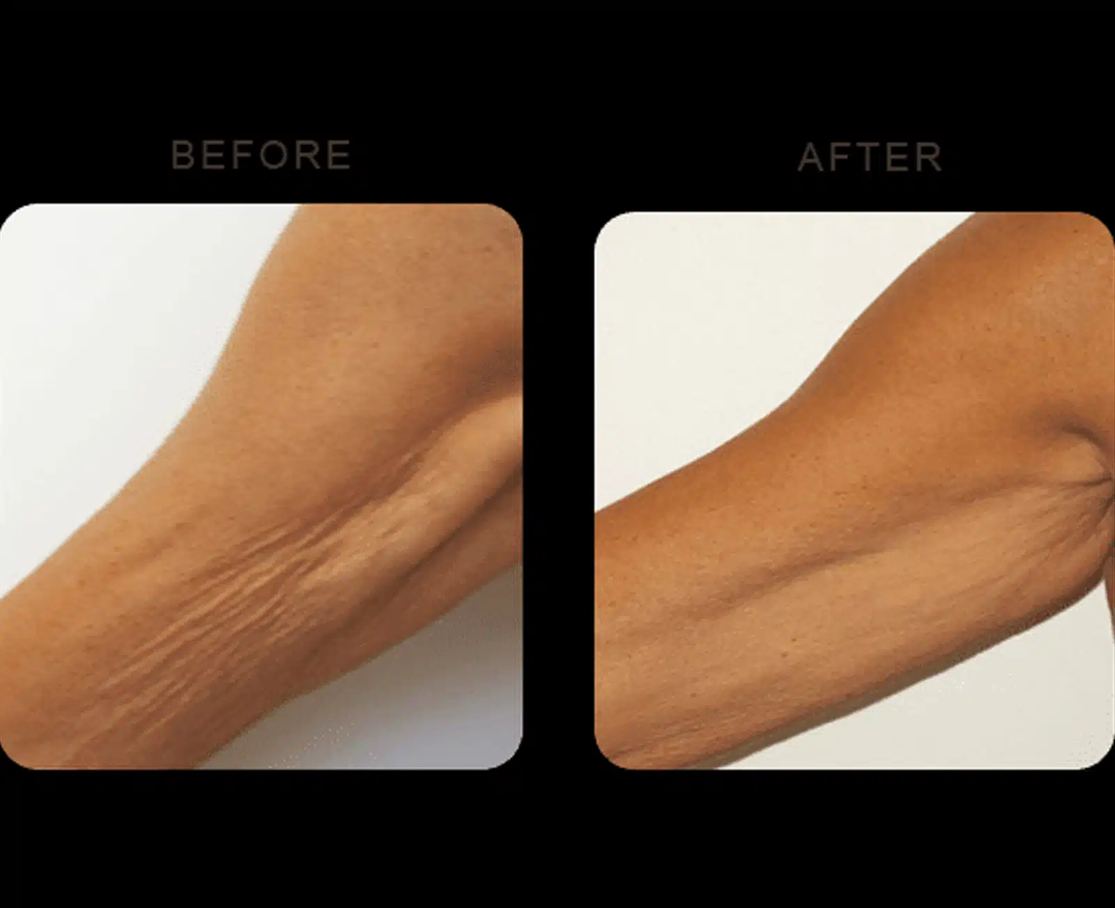 Ideal Candidate for Body Sculpting Ideal Candidate for Body Sculpting