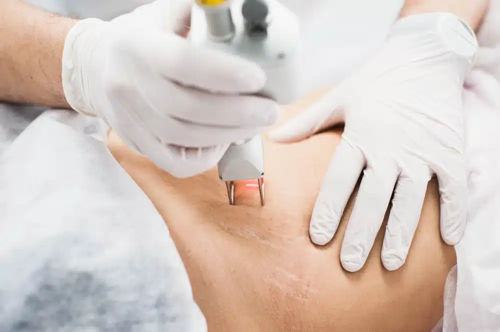 Laser Resurfacing Orlando FL