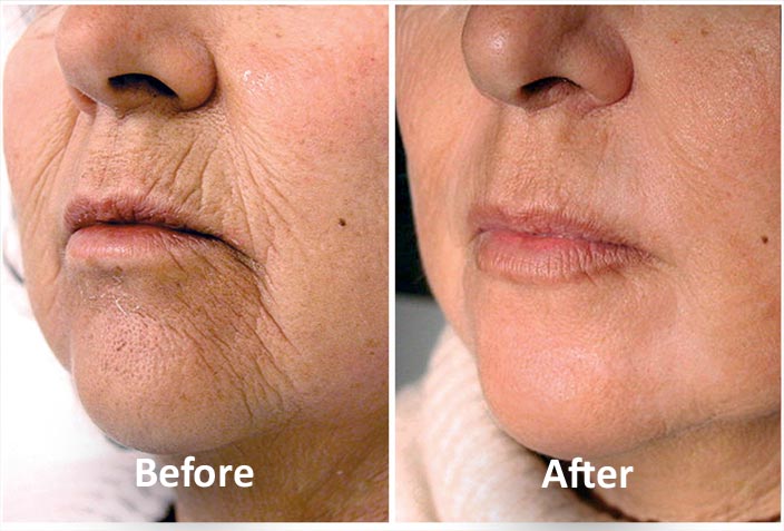 Laser Resurfacing Orlando FL