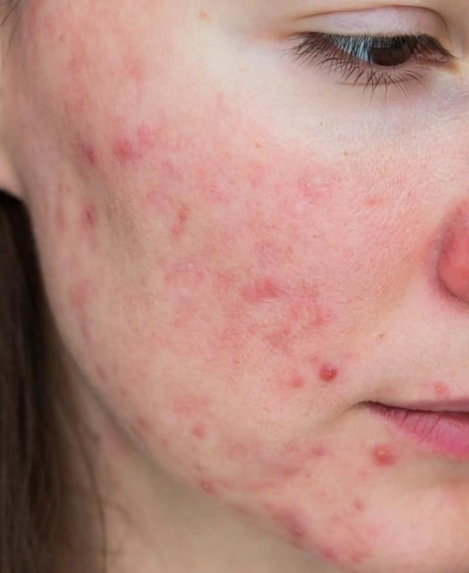 Laser Skin Resurfacing Laser Skin Resurfacing