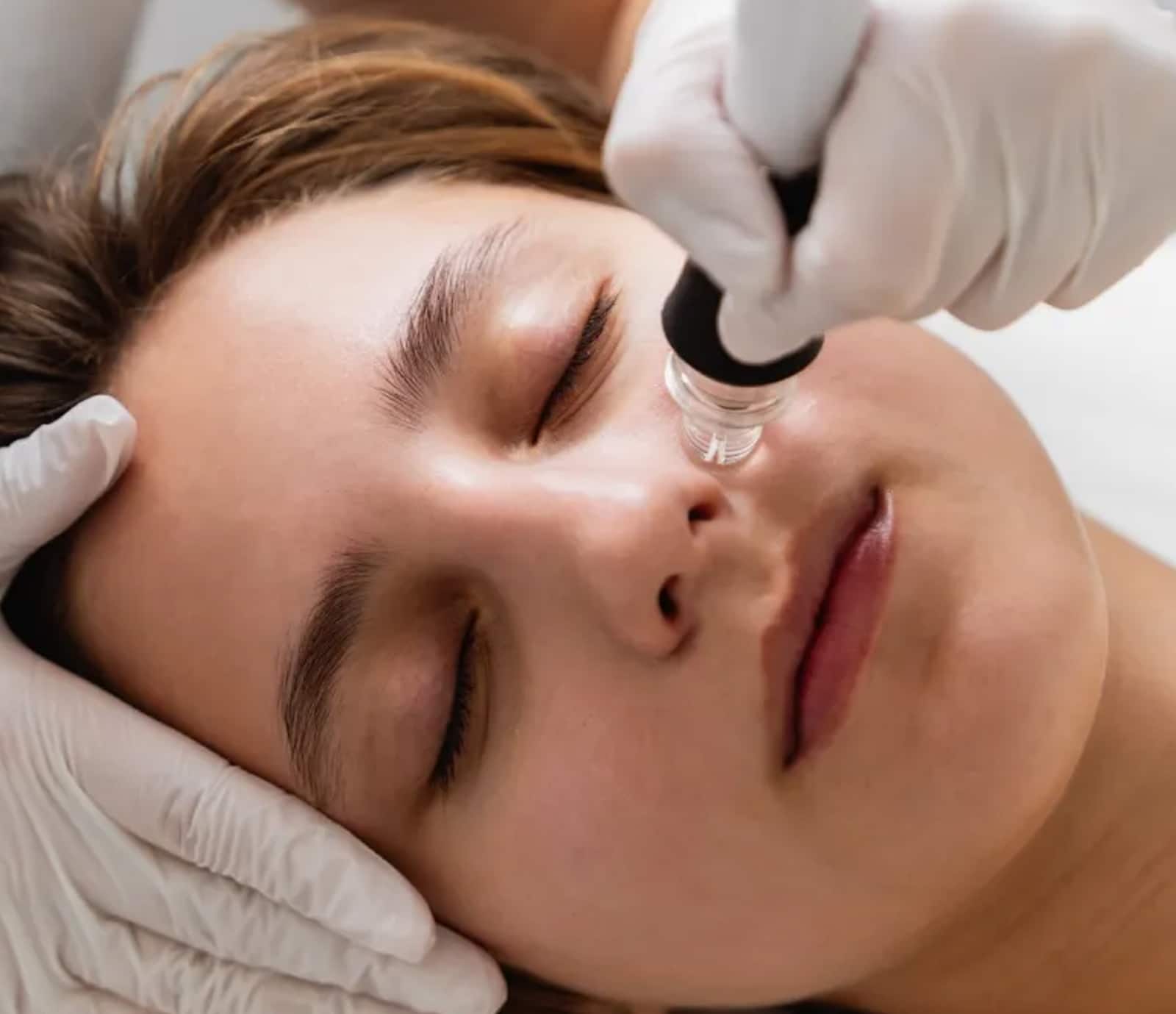 Micro Needling