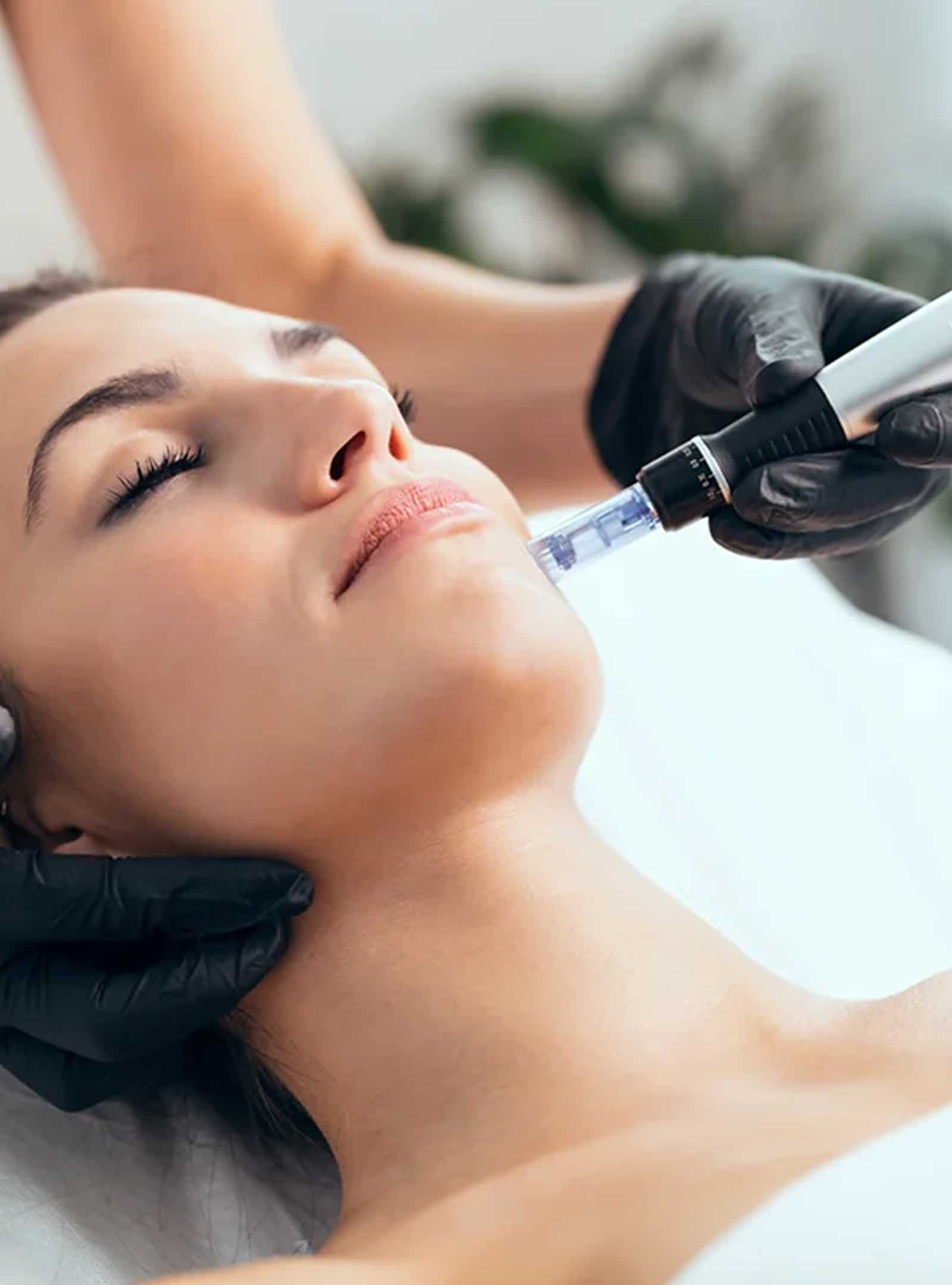 PRP Micro Needling PRP Micro Needling