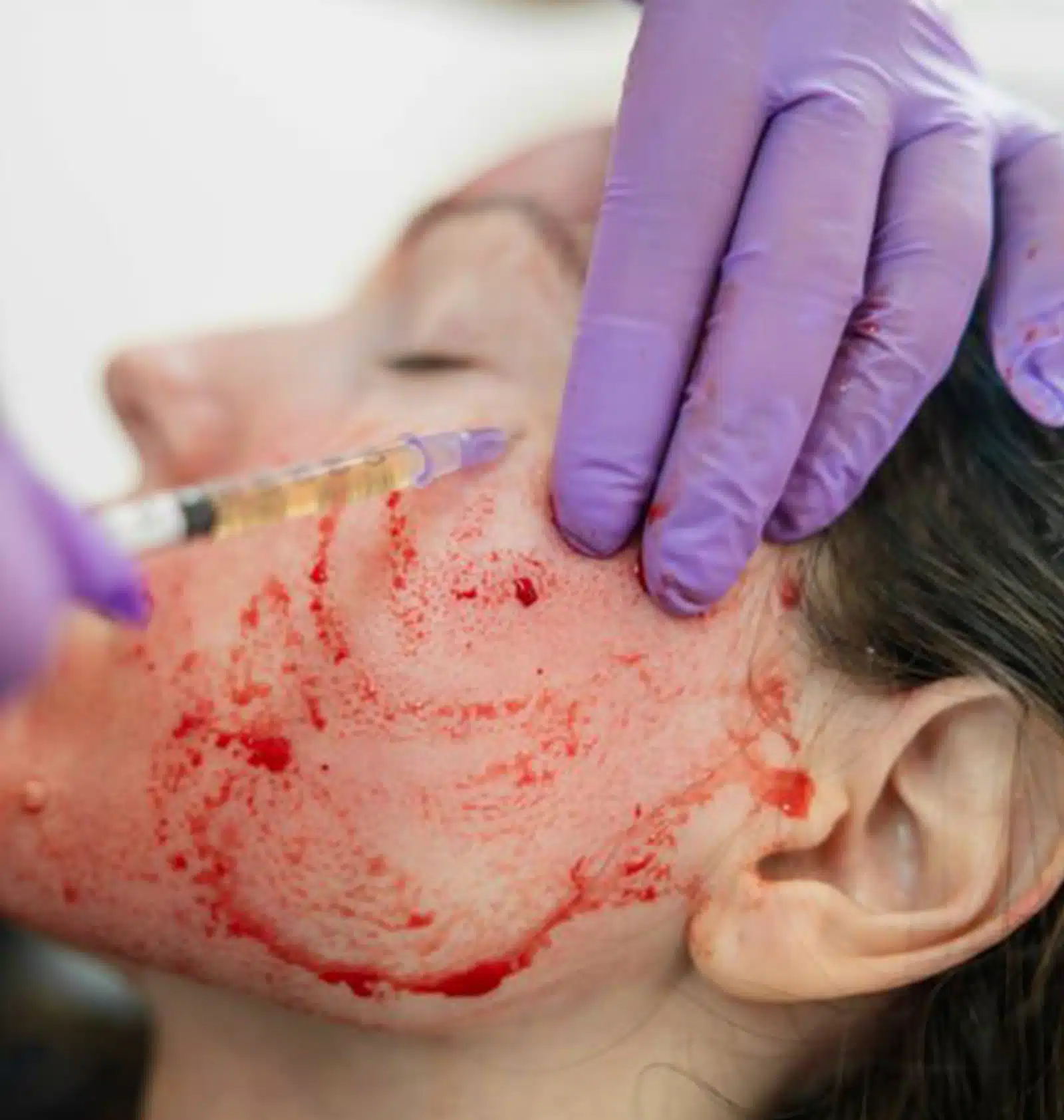 Platelet-Rich Plasma (PRP) comes from your own blood Platelet-Rich Plasma (PRP) comes from your own blood