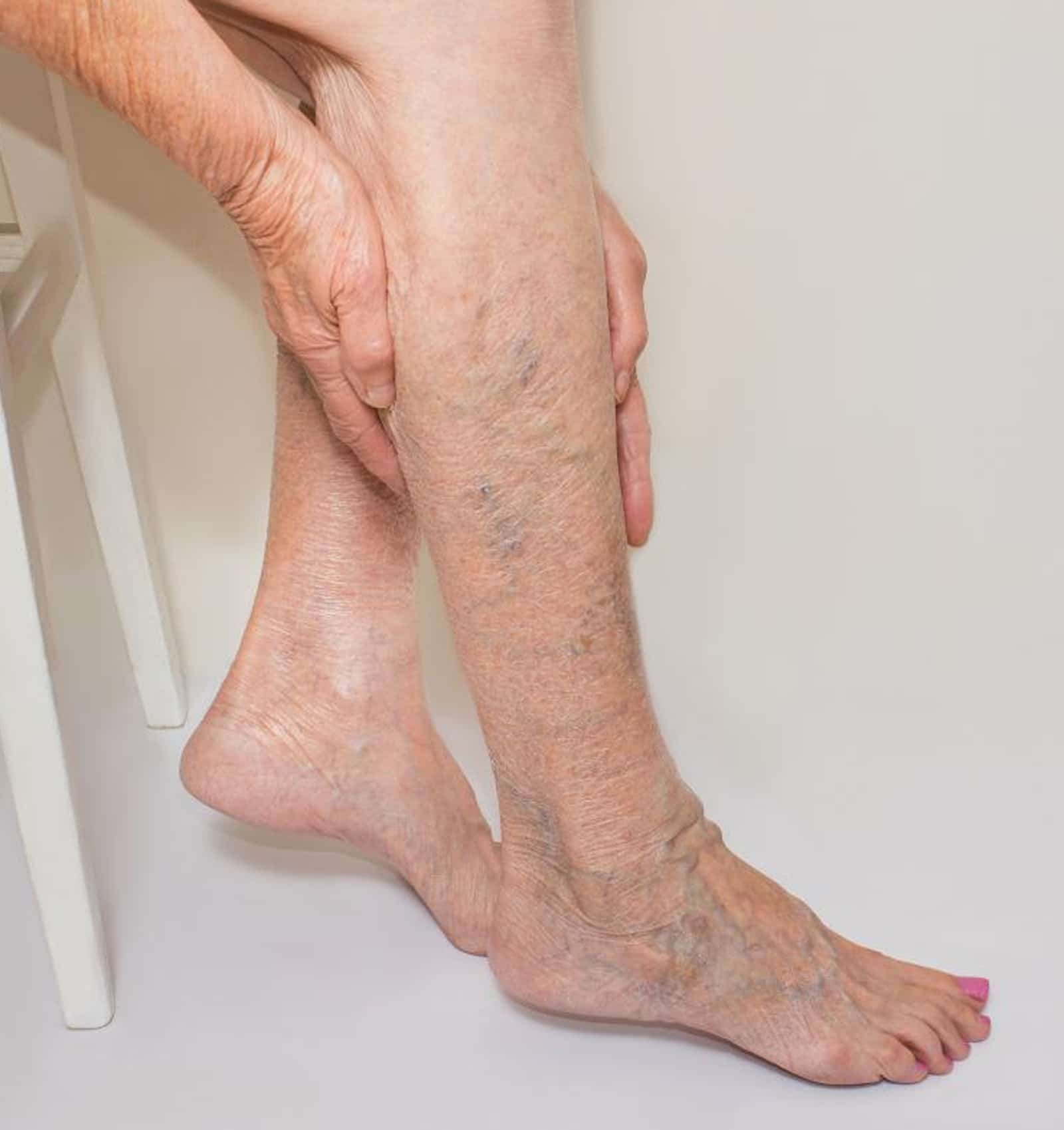 Spider Vein Removal Orlando Spider Vein Removal Orlando