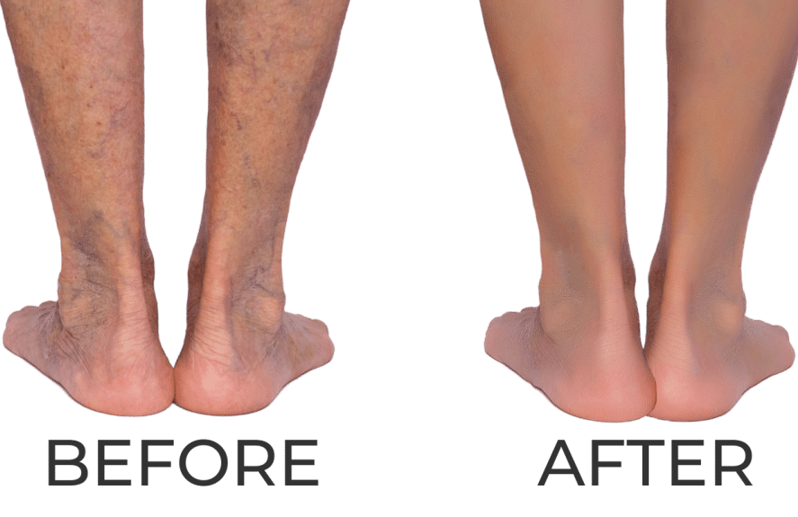 Spider Vein Removal Orlando Comfort and Convenience