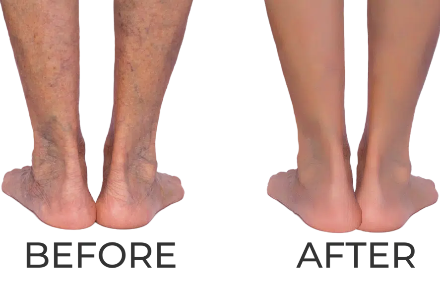 Spider Vein Removal Orlando Comfort and Convenience