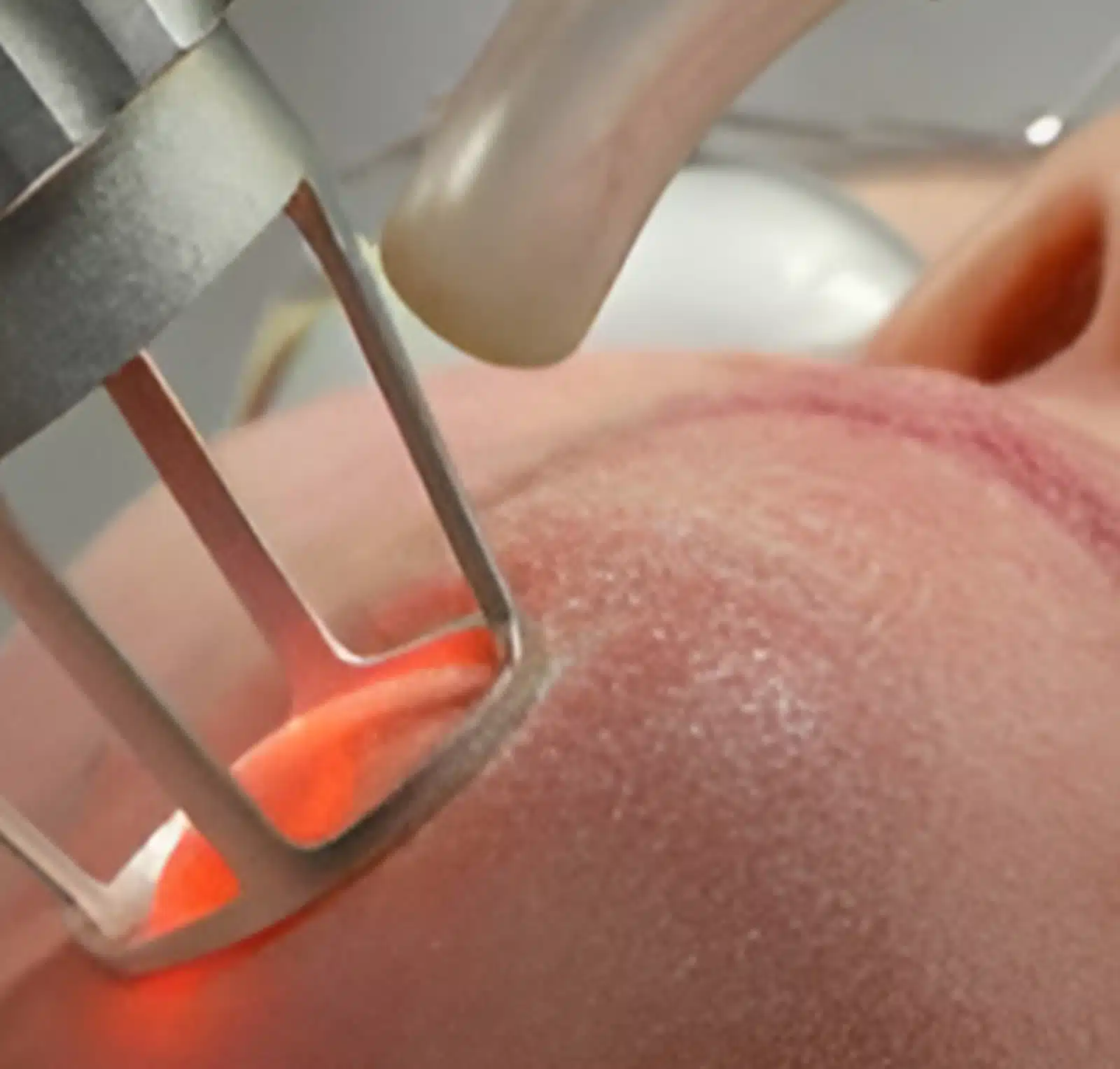 Wymore Laser for Acne Scar Treatment Wymore Laser for Acne Scar Treatment