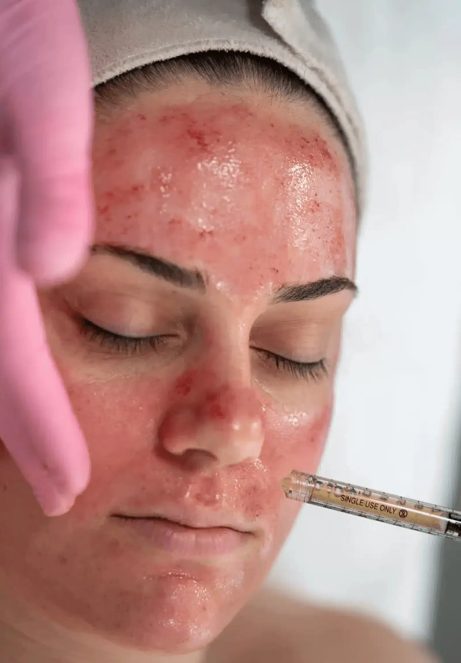 treatment at Wymore Laser treatment at Wymore Laser