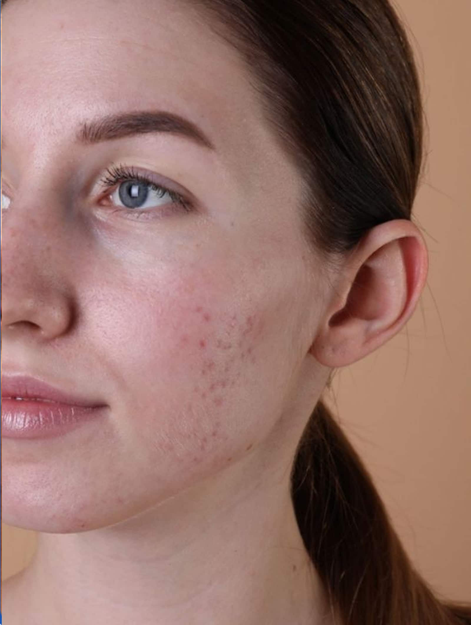 Acne scars and blemishes
