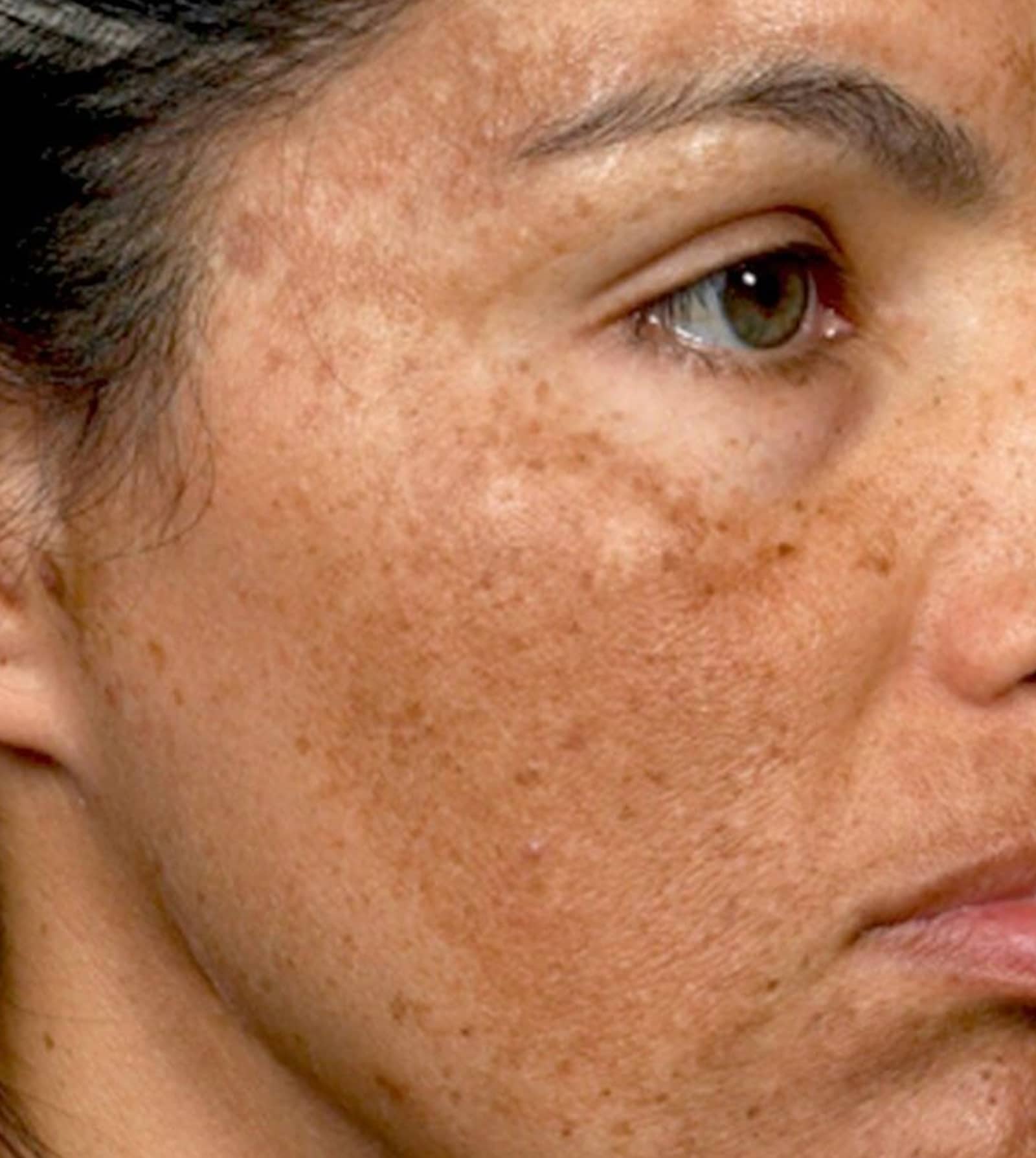 Common Triggers of Melasma Common Triggers of Melasma