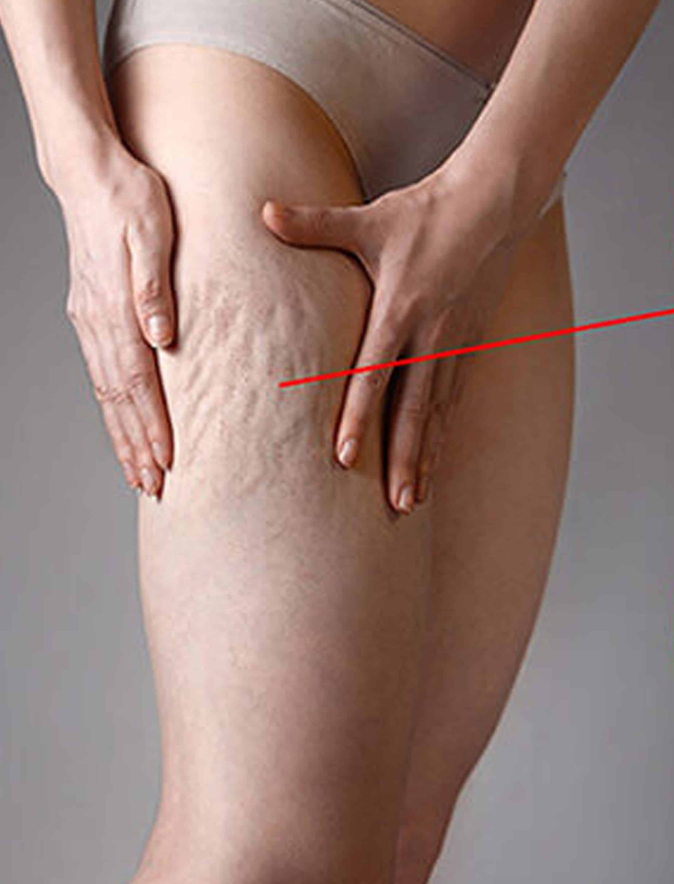 Laser-Assisted Cellulite Reduction Laser-Assisted Cellulite Reduction