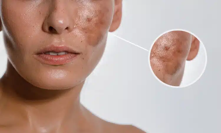 Melasma Treatment Orlando