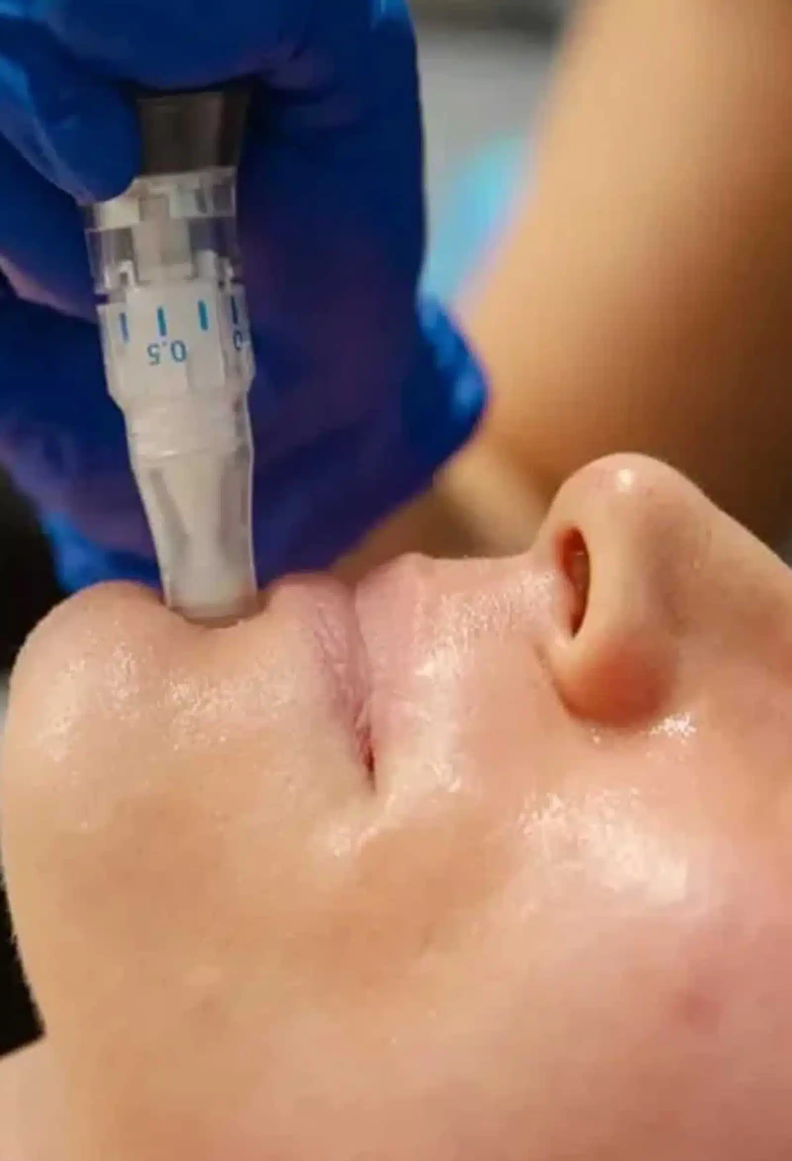 Microneedling Treatment