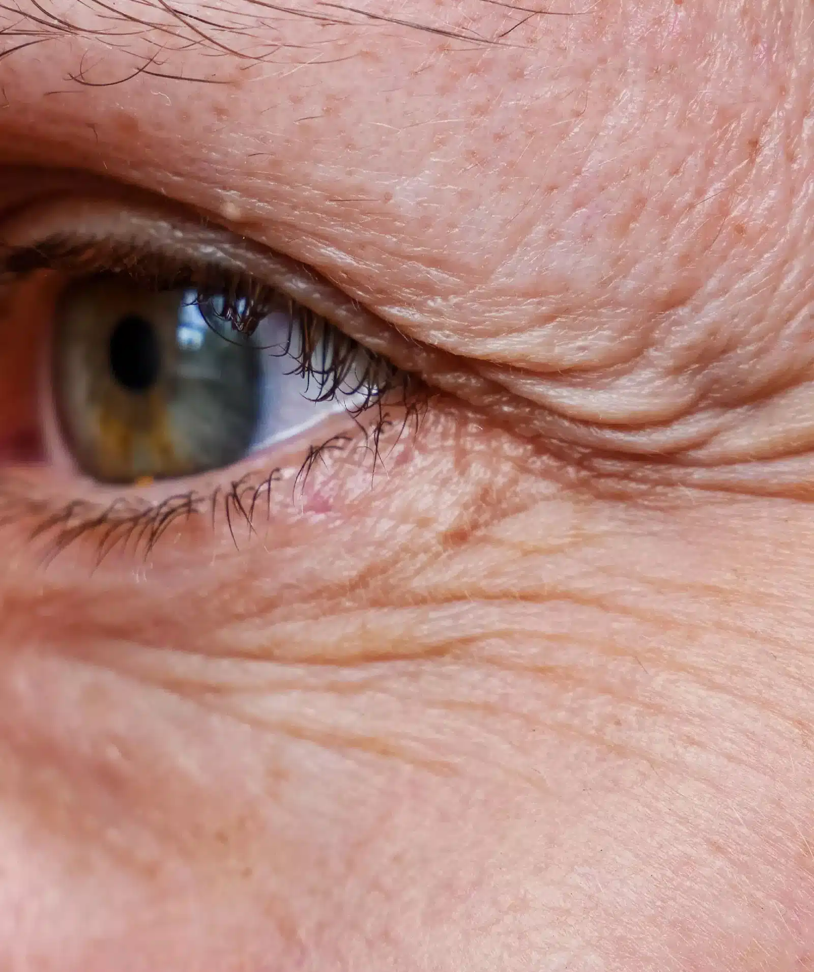 Types of Under-Eye Wrinkles Types of Under-Eye Wrinkles