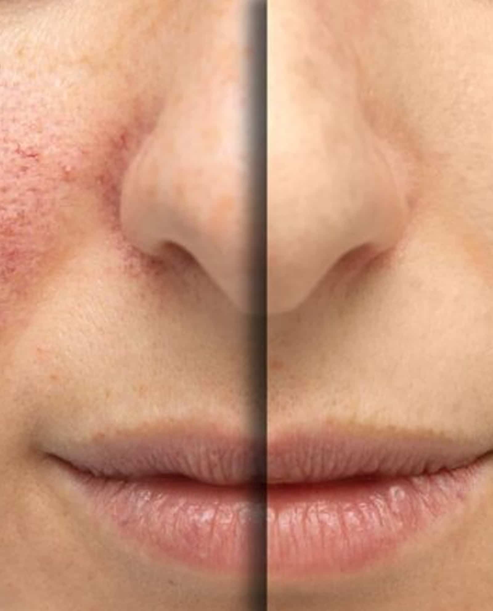 Benefit from IPL Rosacea jpg Benefit from IPL Rosacea jpg
