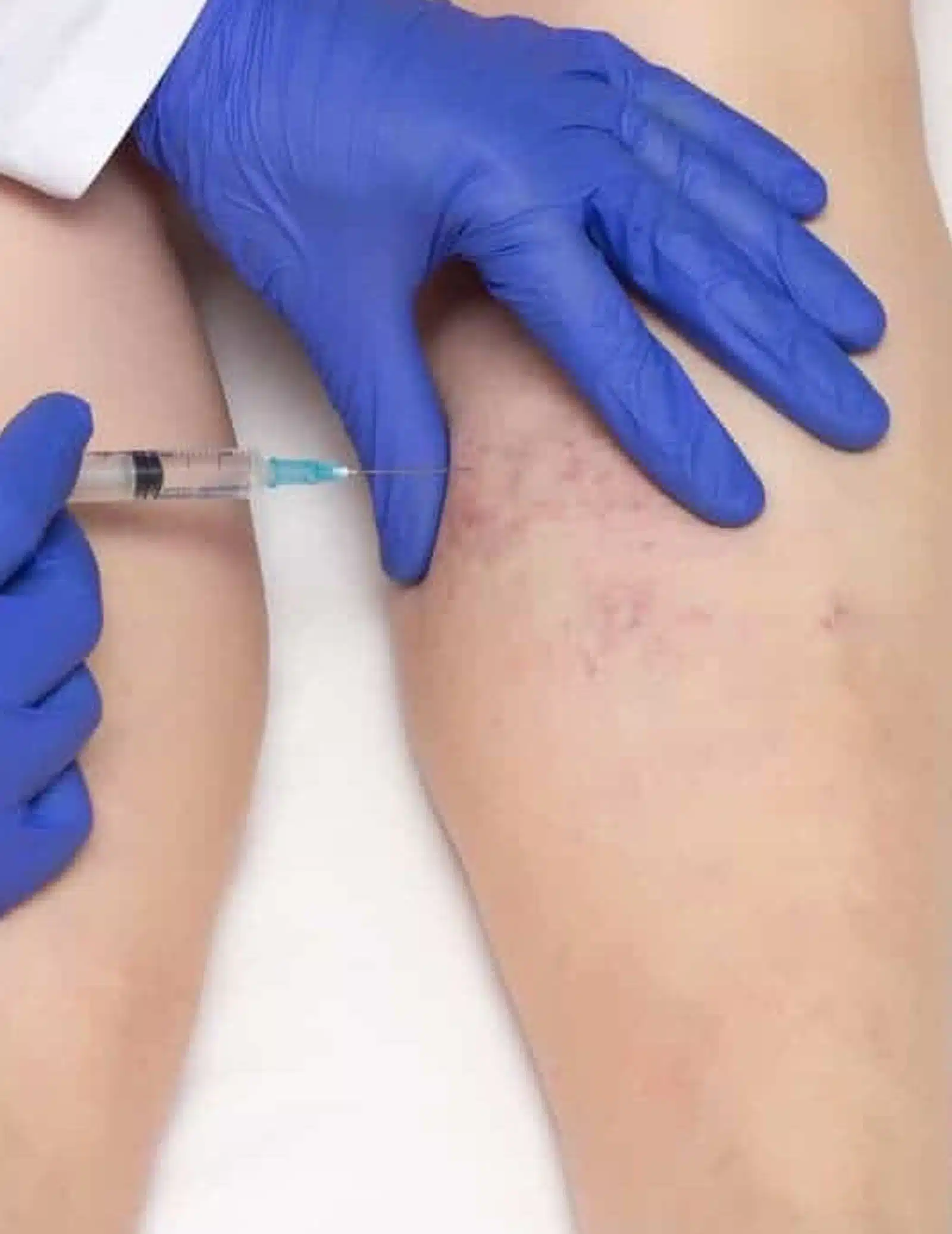 Benefit from Sclerotherapy Benefit from Sclerotherapy