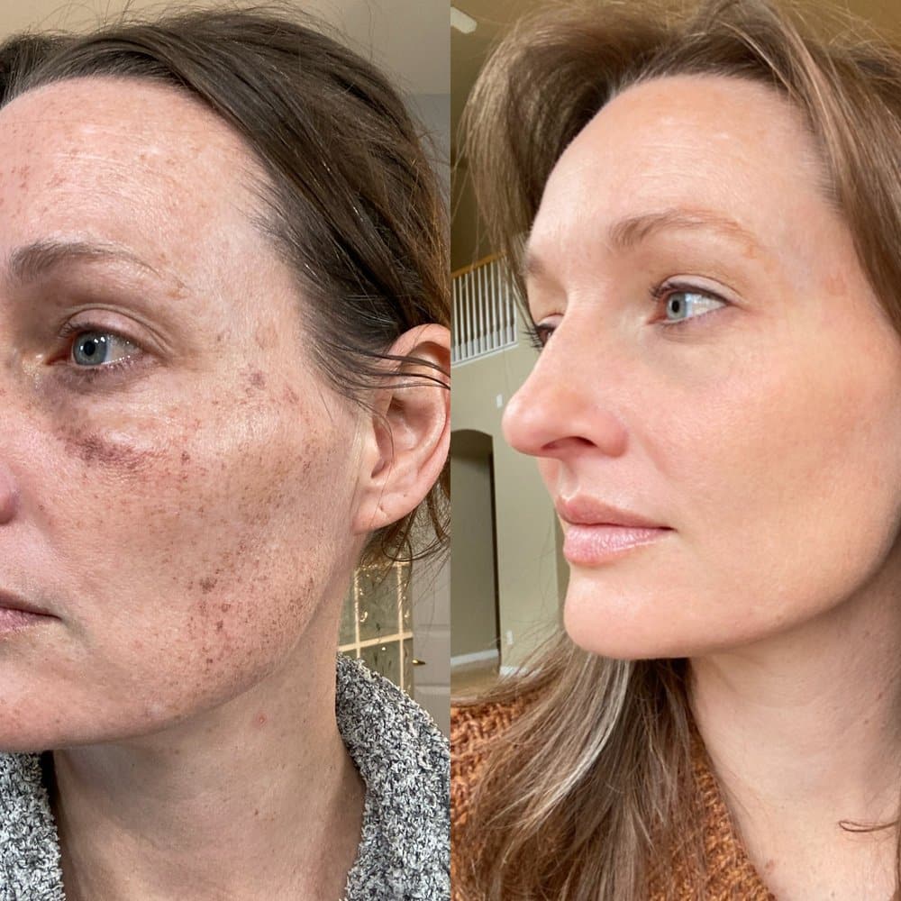 Best Melasma Treatment Near Me Winter Park FL