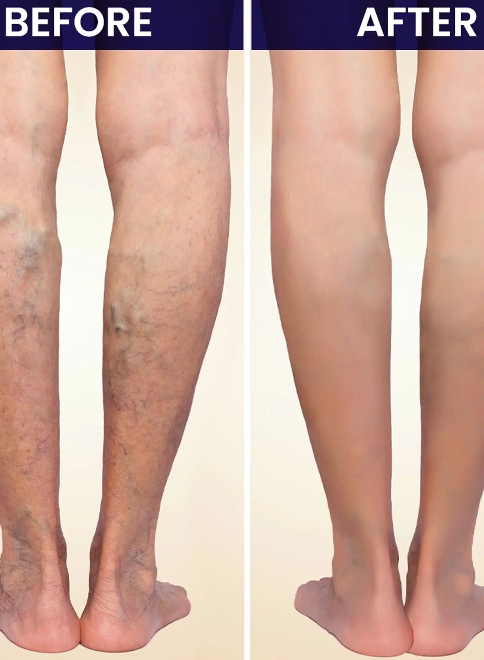 Bulging veins that worsen over time Bulging veins that worsen over time