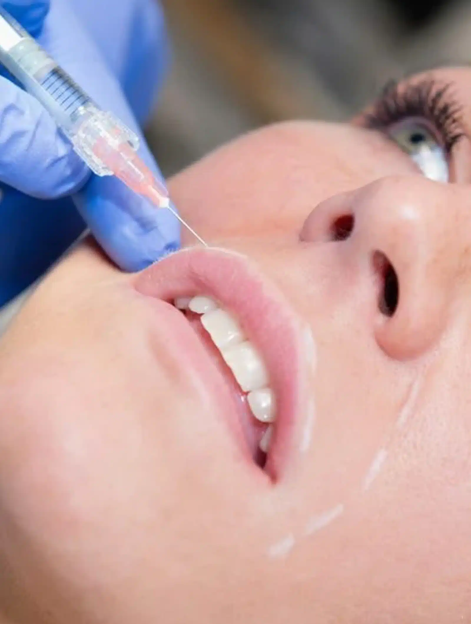 Combining Fillers Combining Fillers