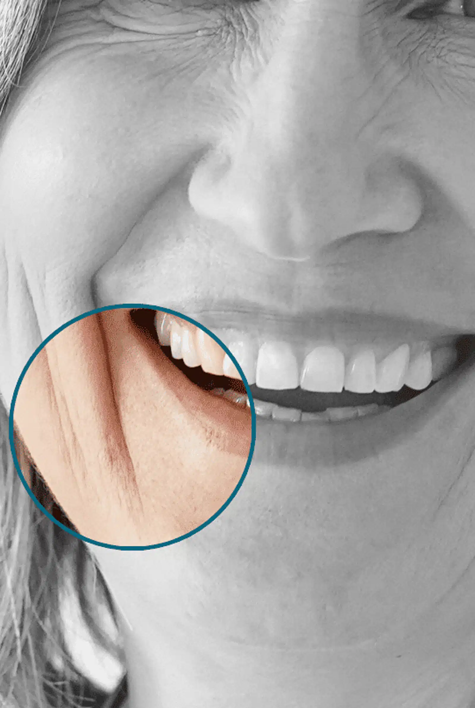 Dermal Fillers for Marionette Lines Dermal Fillers for Marionette Lines