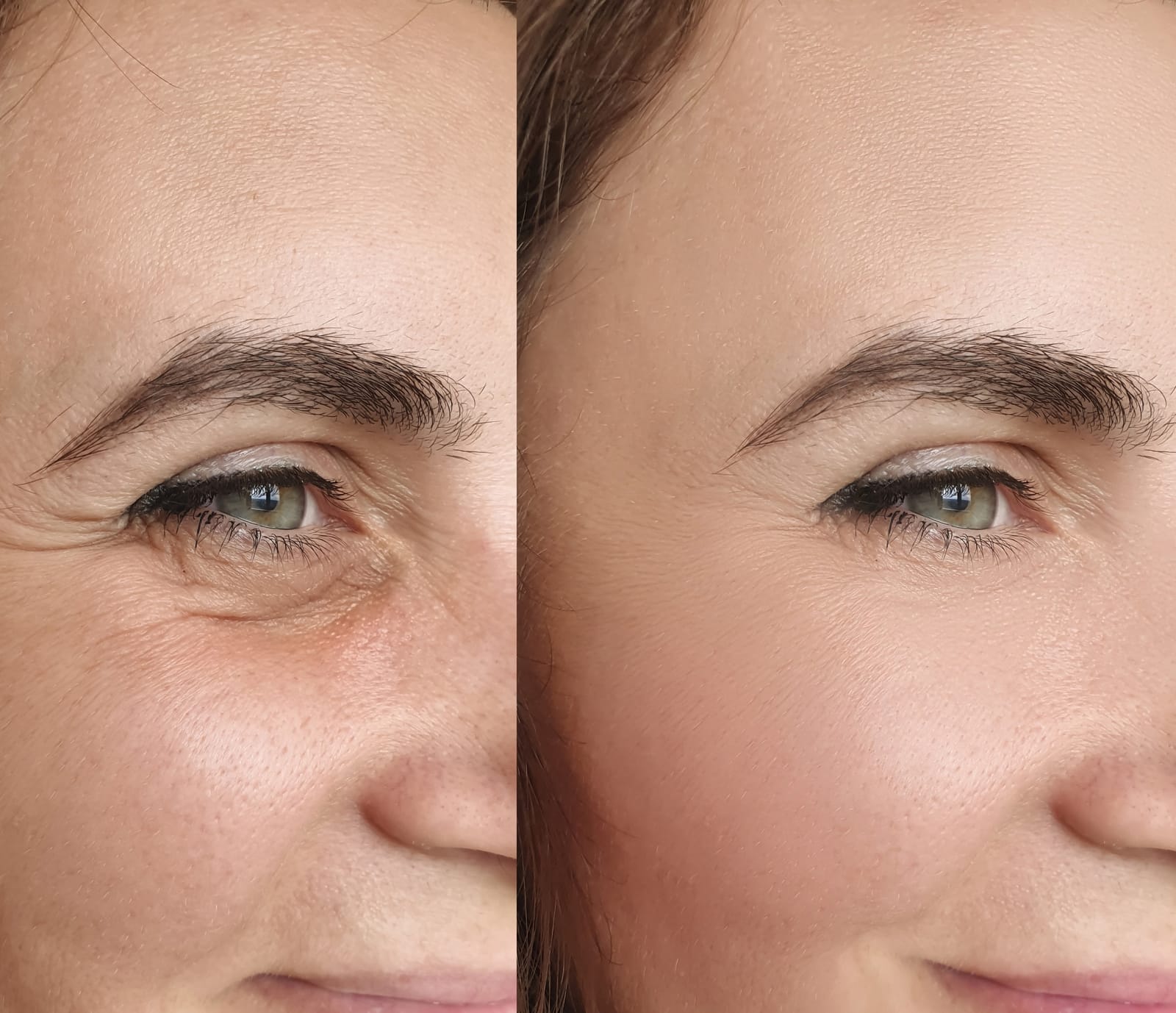 Dysport for Eye Wrinkles Dysport for Eye Wrinkles