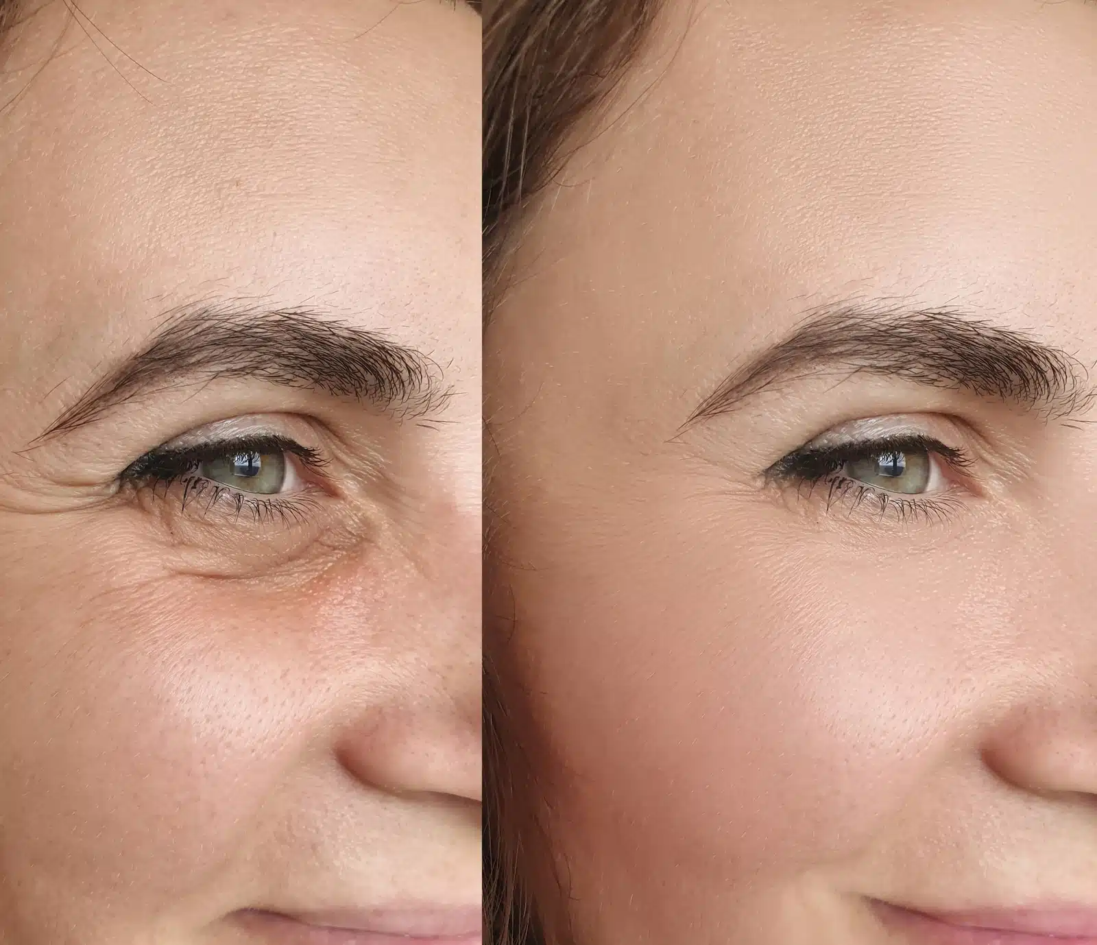 Dysport for Eye Wrinkles Dysport for Eye Wrinkles