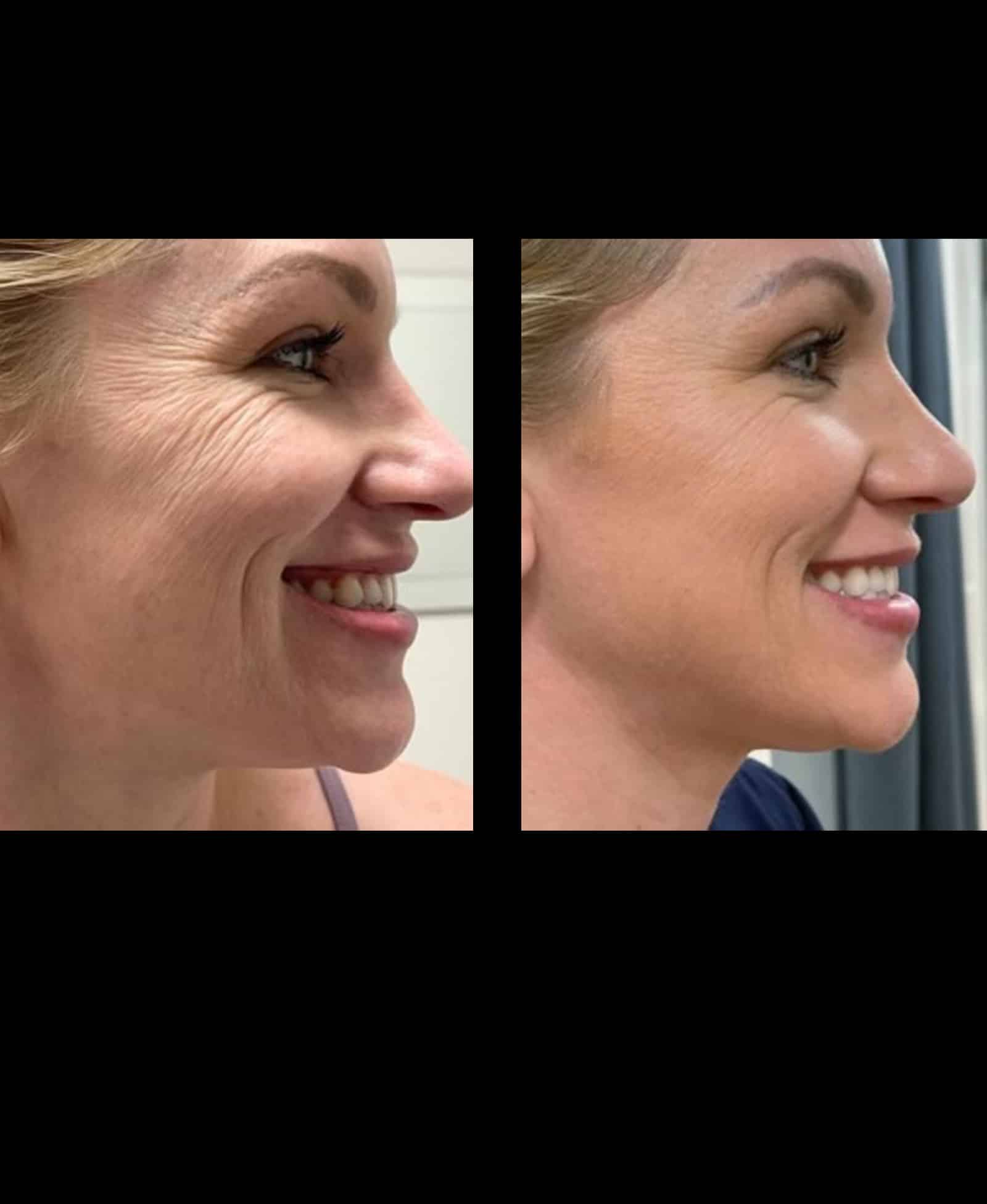 Dysport for Nose