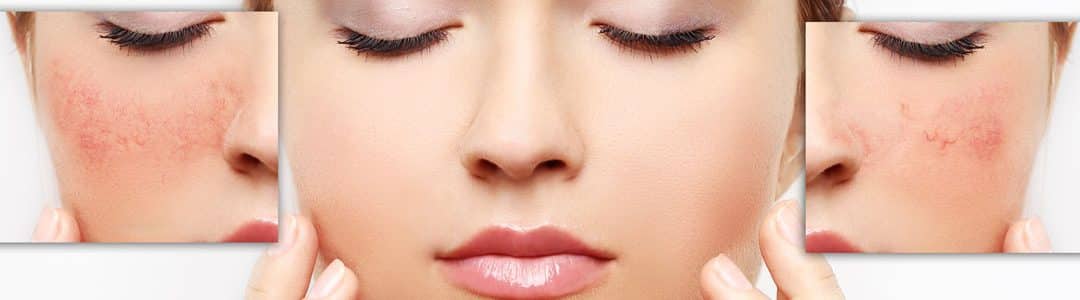 Effective Redness Treatment Winter Park