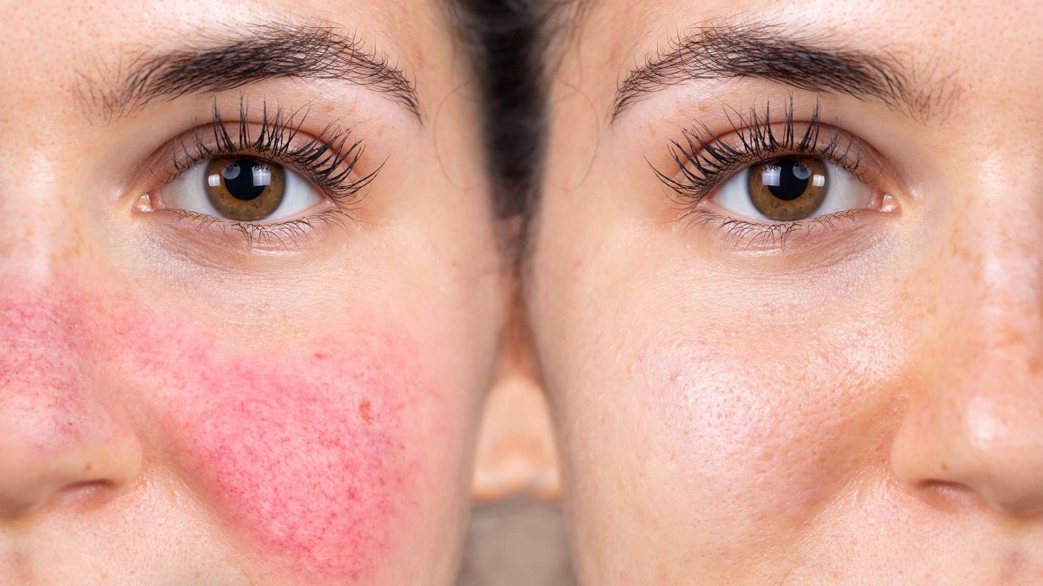 Effective Redness Treatment Winter Park