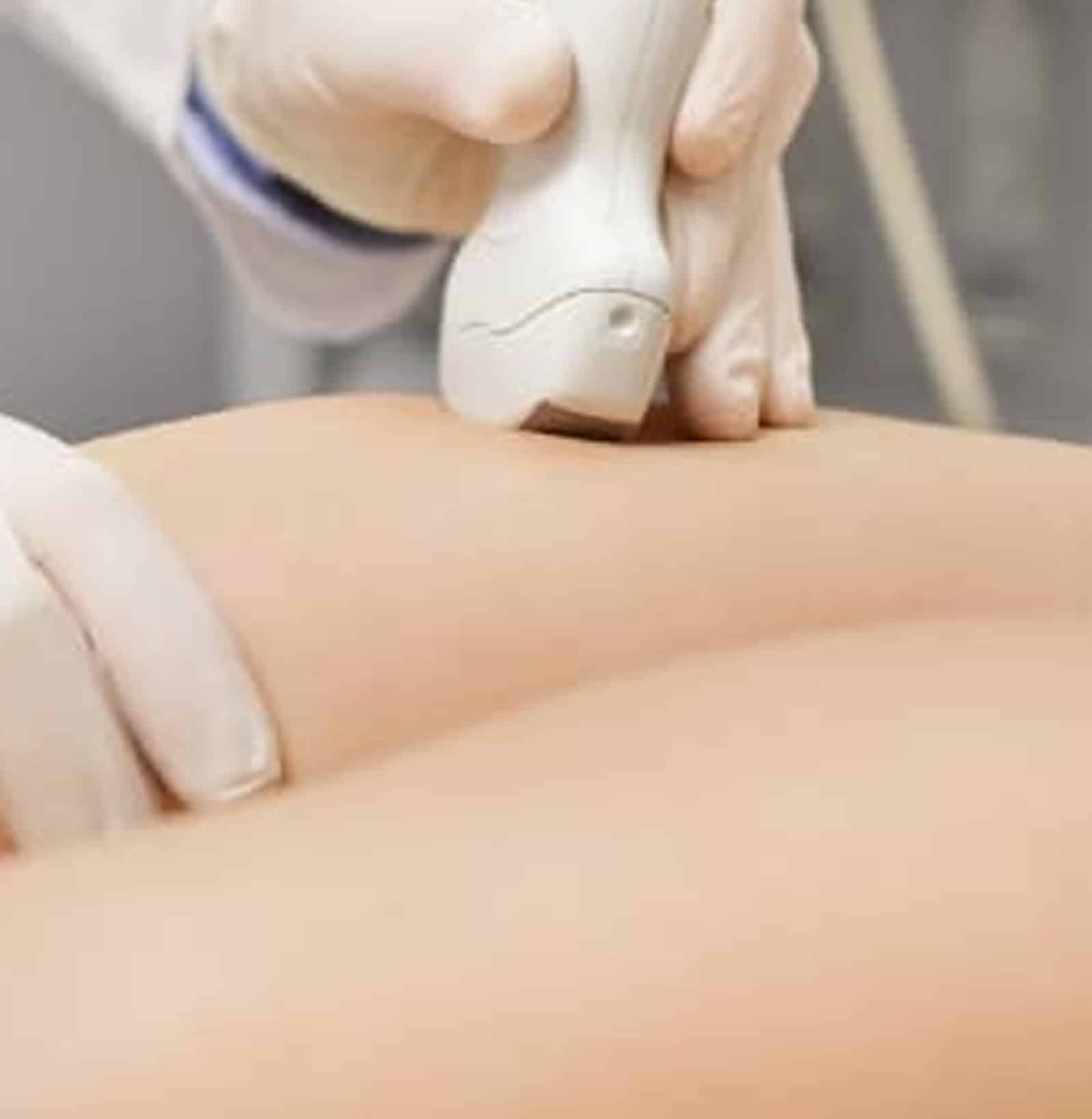 Expert Sclerotherapy Services How It Works Expert Sclerotherapy Services How It Works
