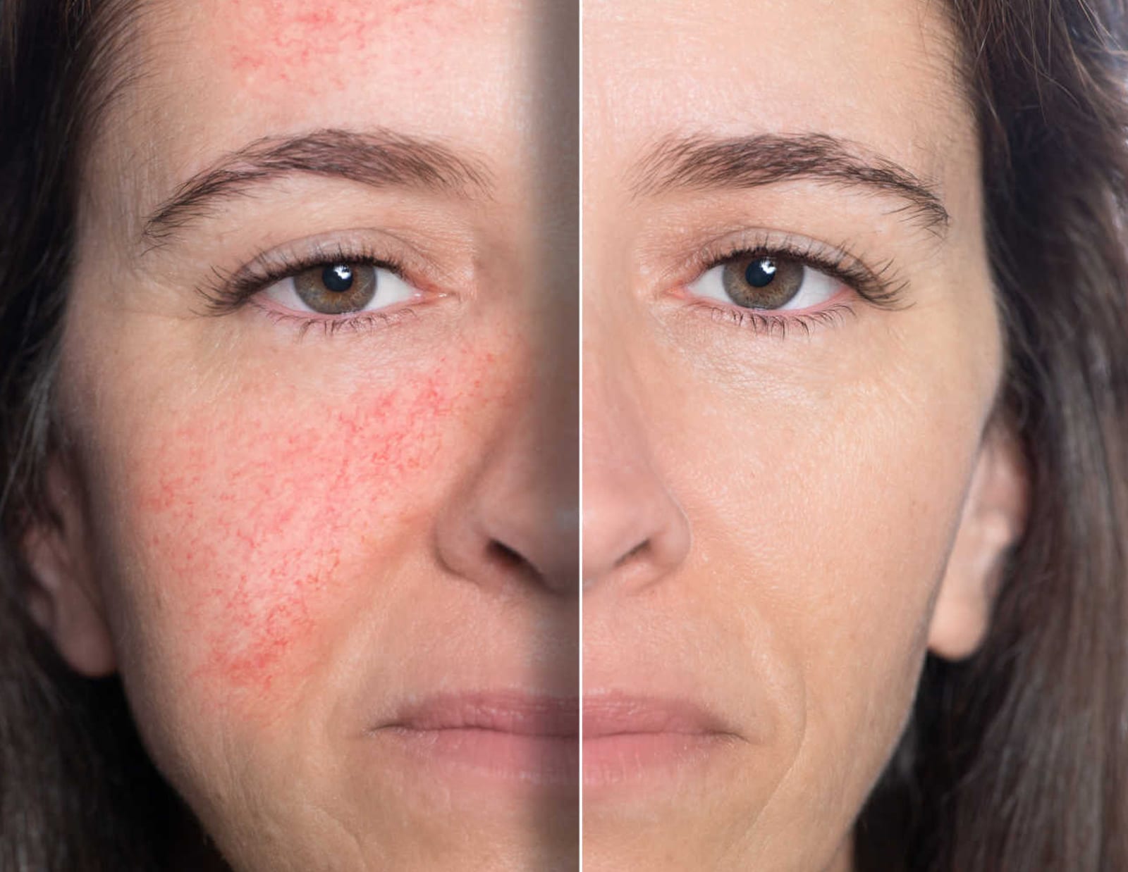 Facial Redness & Flushing