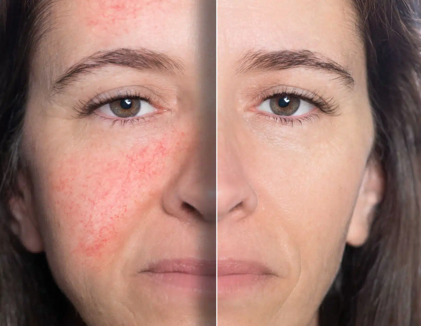 Facial Redness & Flushing Facial Redness & Flushing