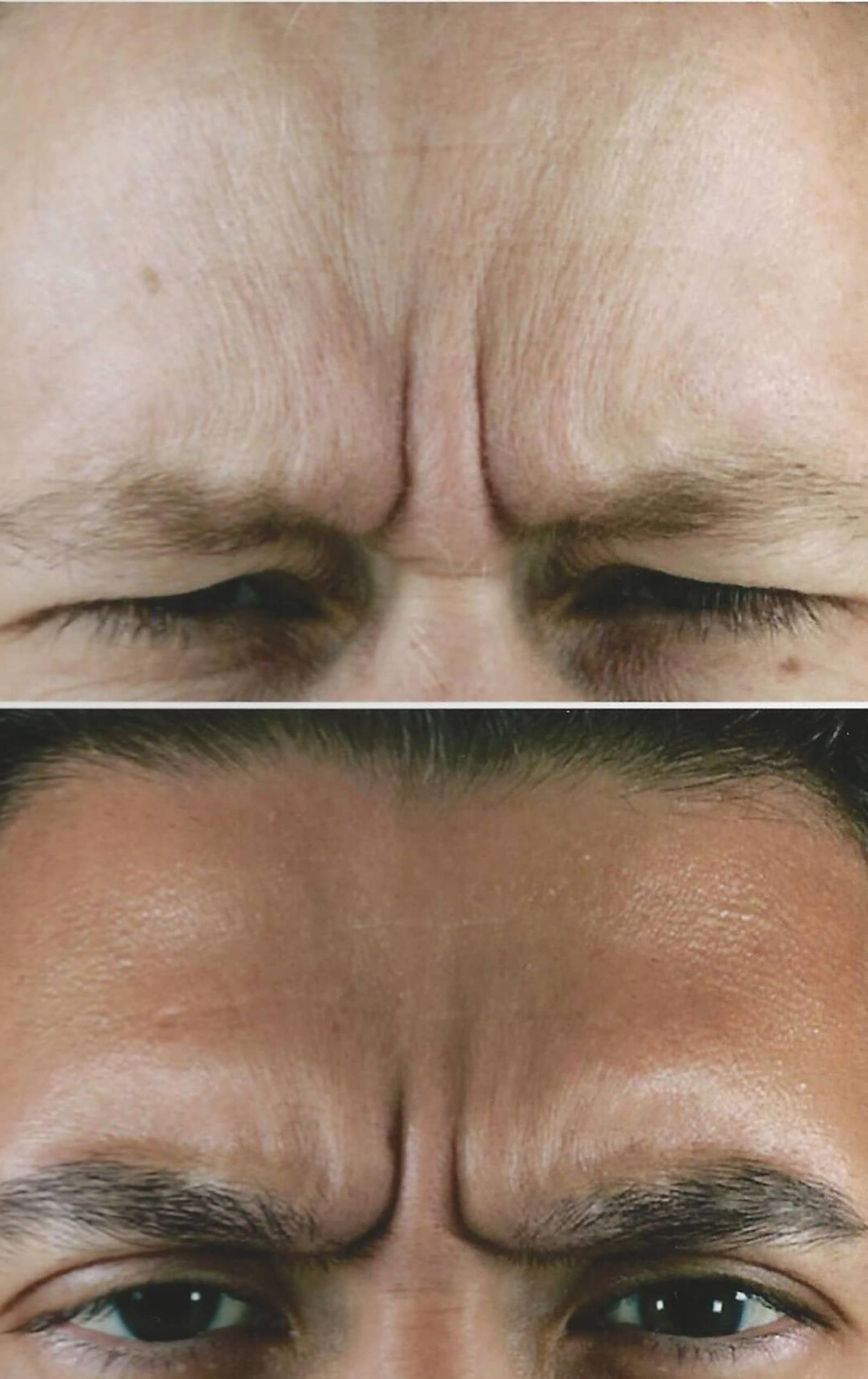 Filler Treatment Advantages Filler Treatment Advantages