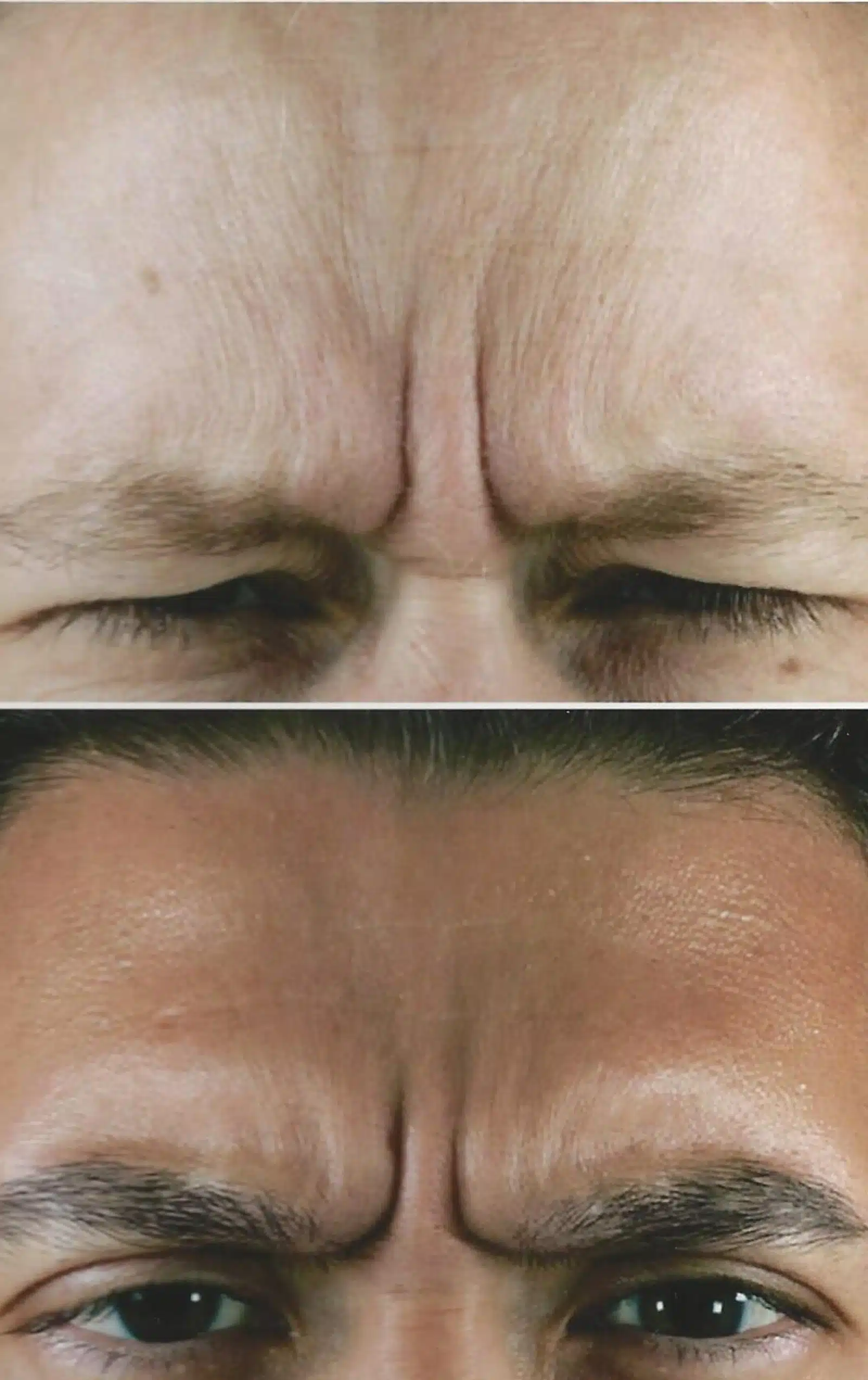Filler Treatment Advantages Filler Treatment Advantages
