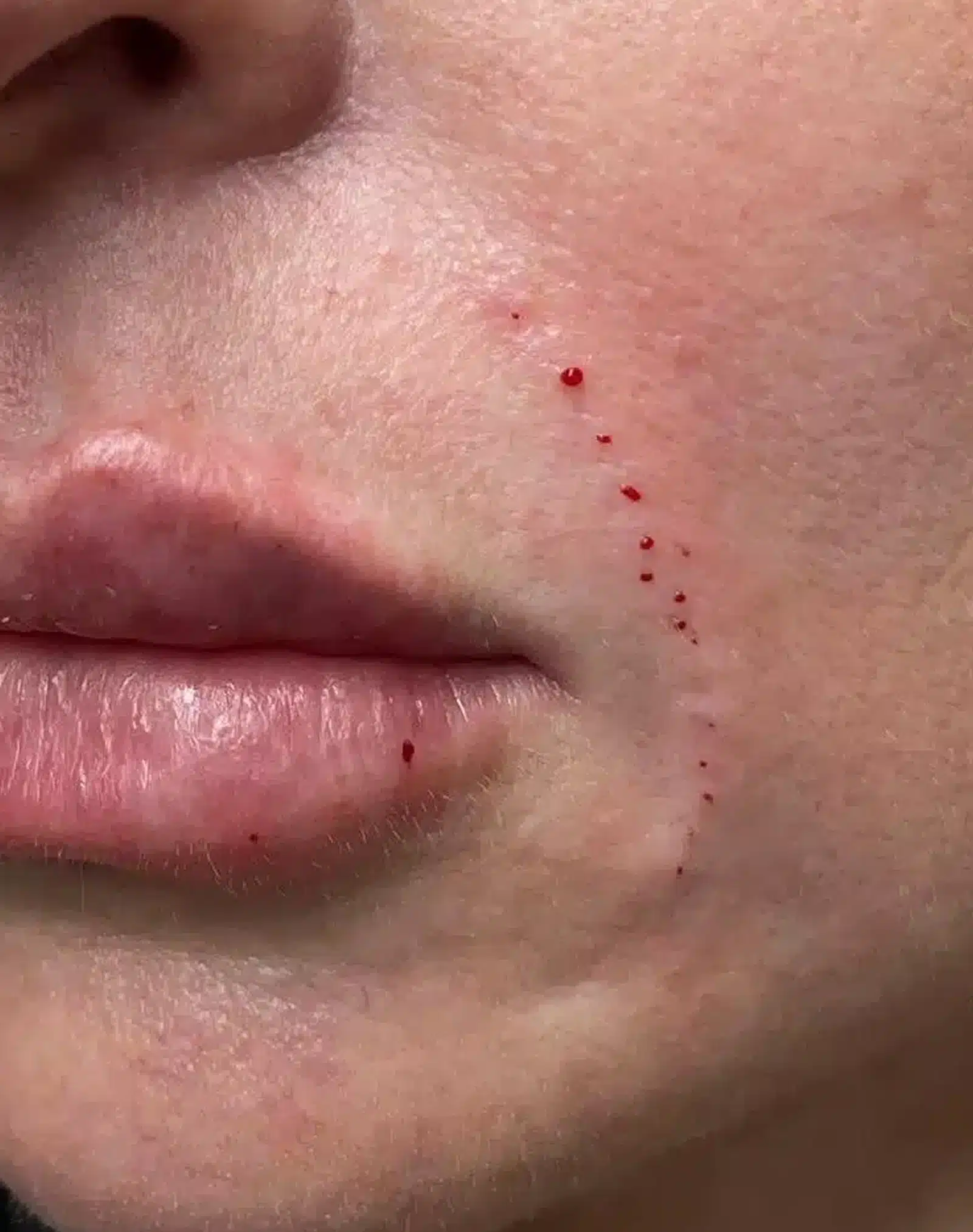 Fillers vs. Surgical Options Fillers vs. Surgical Options