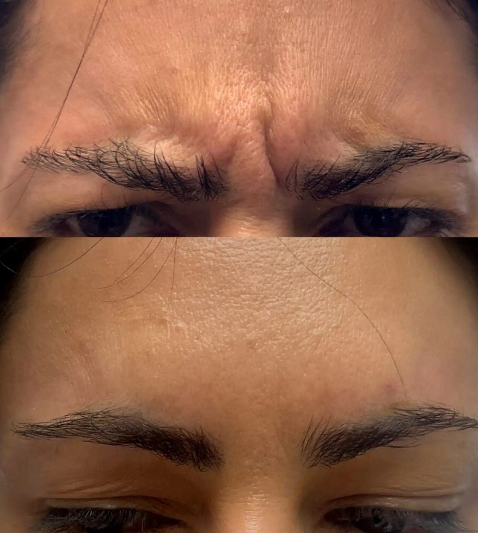 Frown Lines with Advanced Glabellar Line Treatment