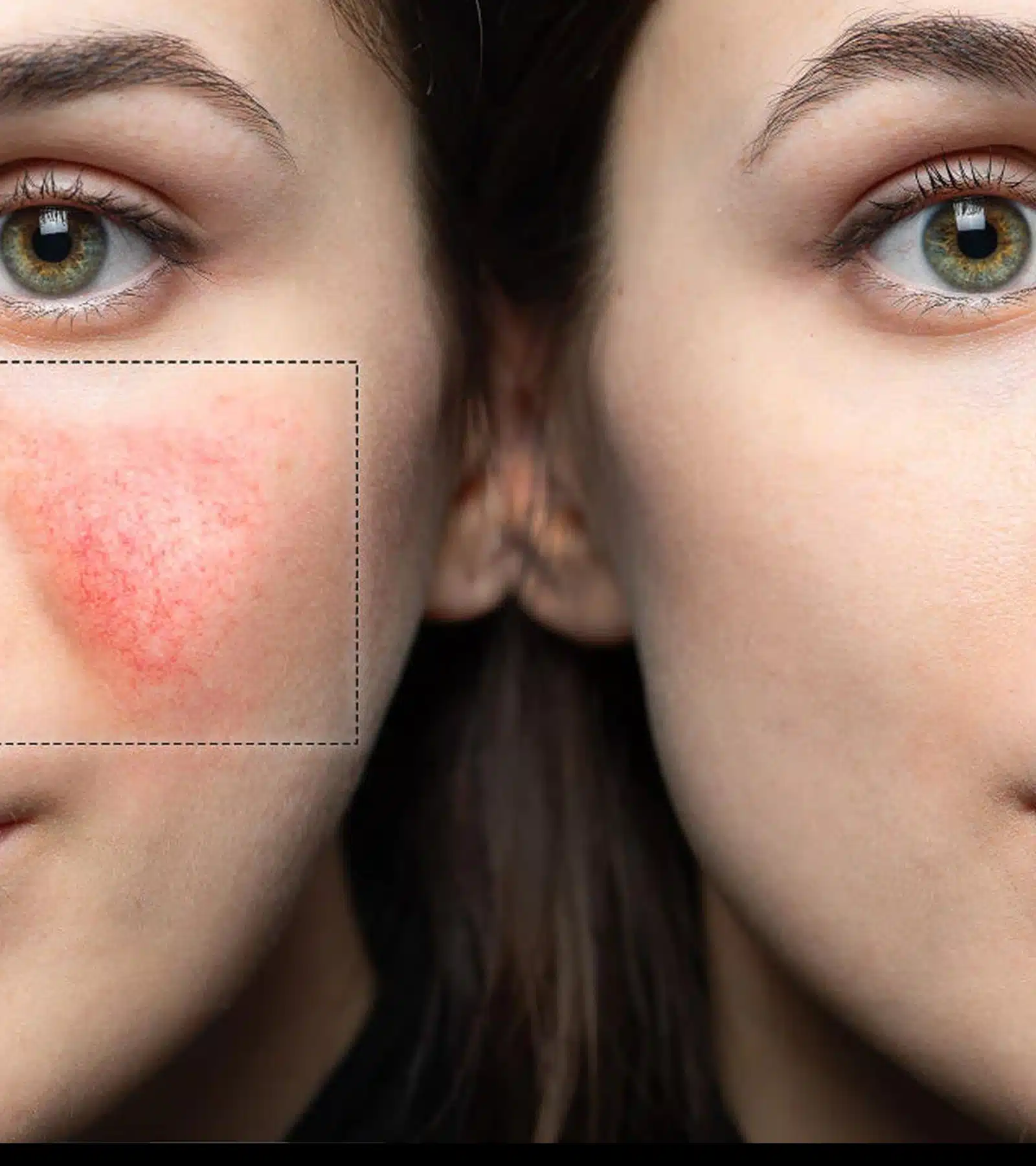 IPL Rosacea Solutions