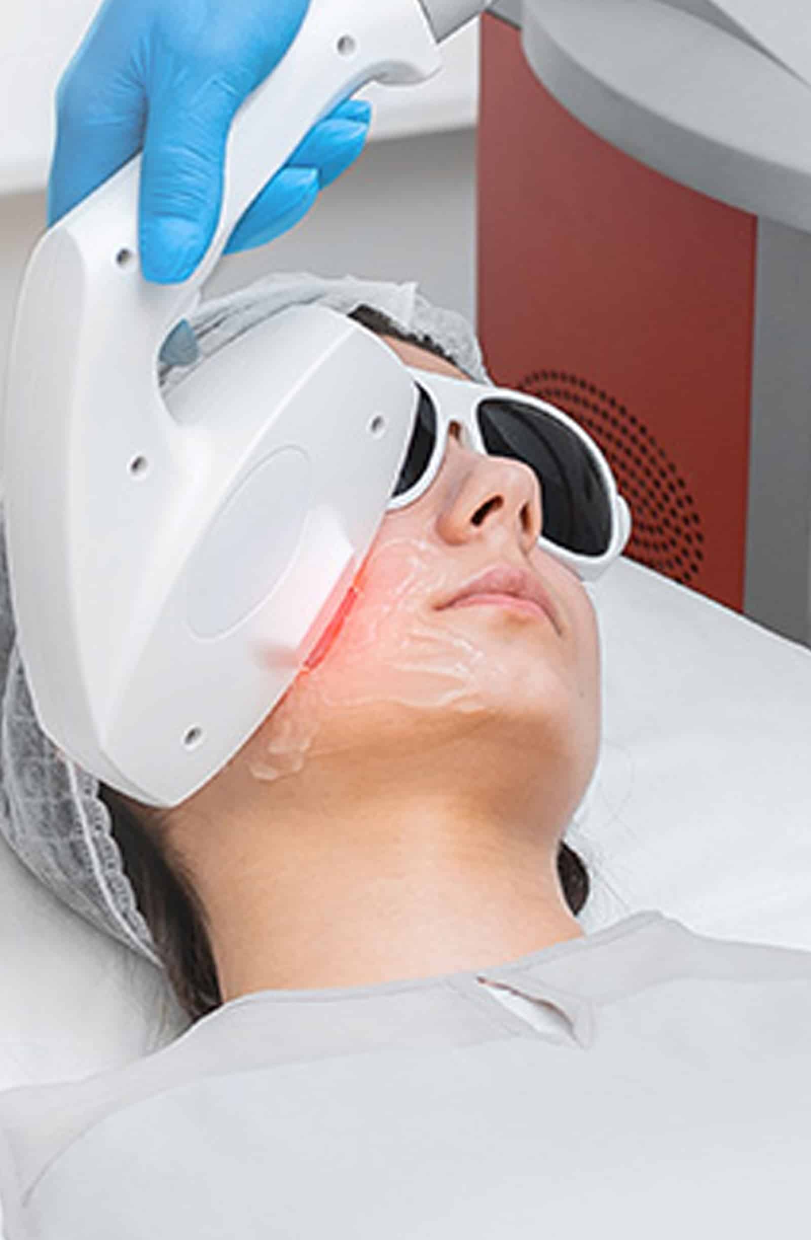 IPL Rosacea Treatment IPL Rosacea Treatment