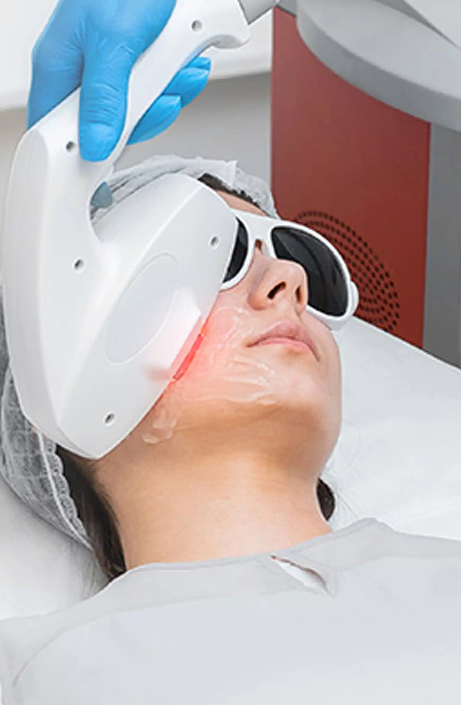 IPL Rosacea Treatment IPL Rosacea Treatment