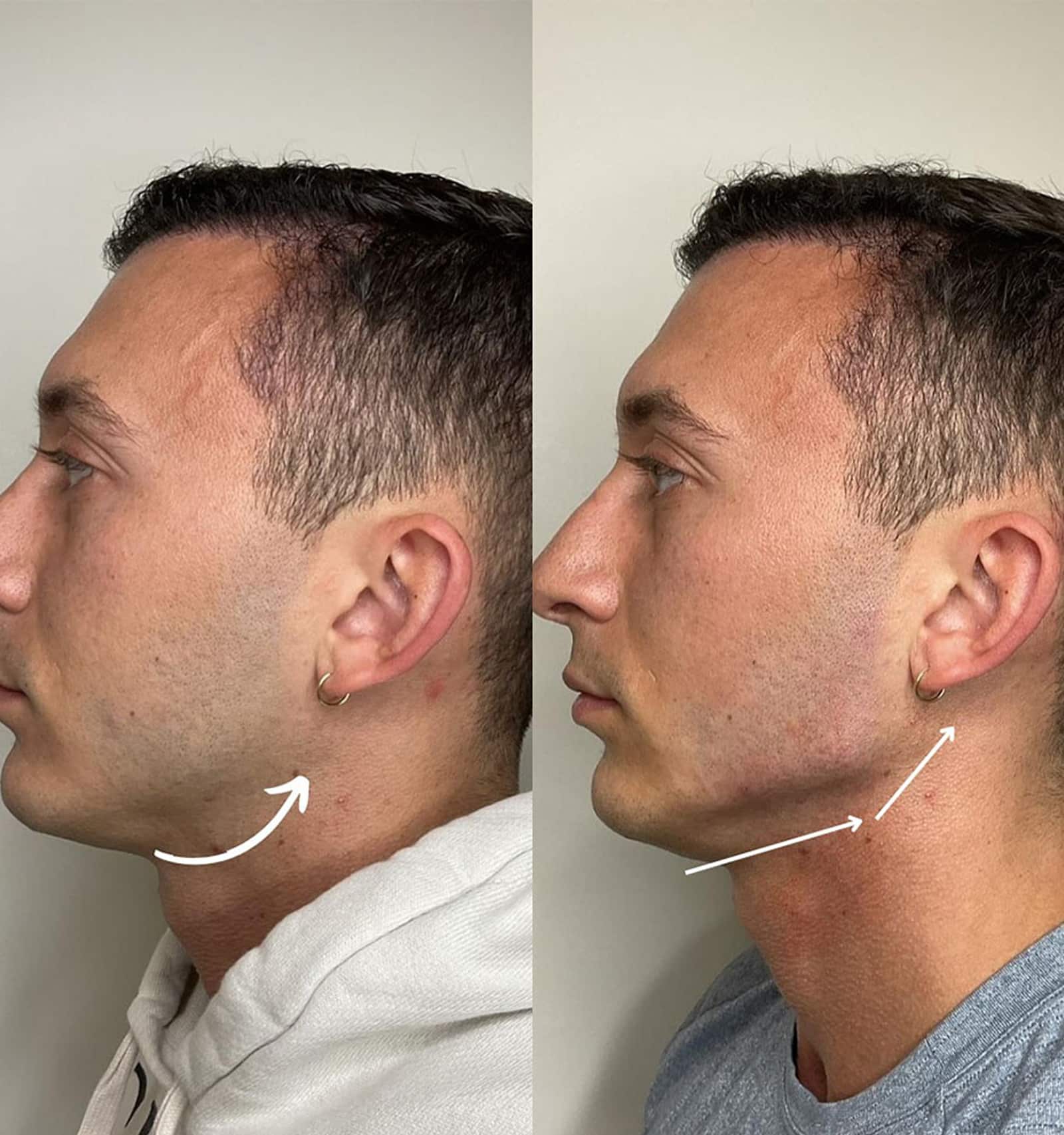Jawline Enhances Facial Harmony
