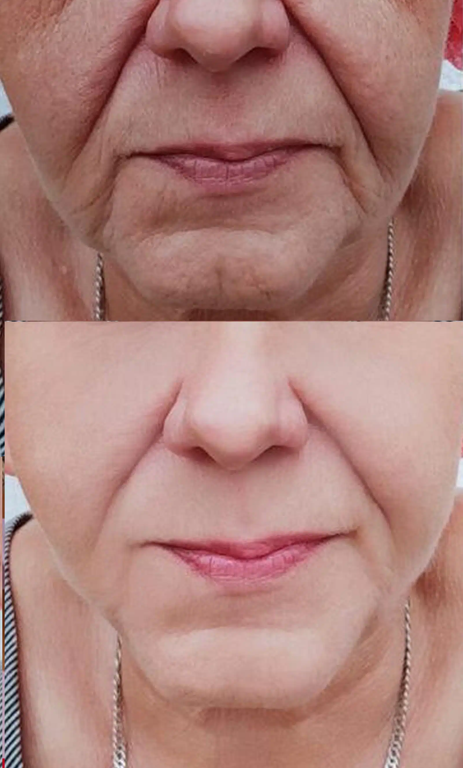 Marionette Lines Develop